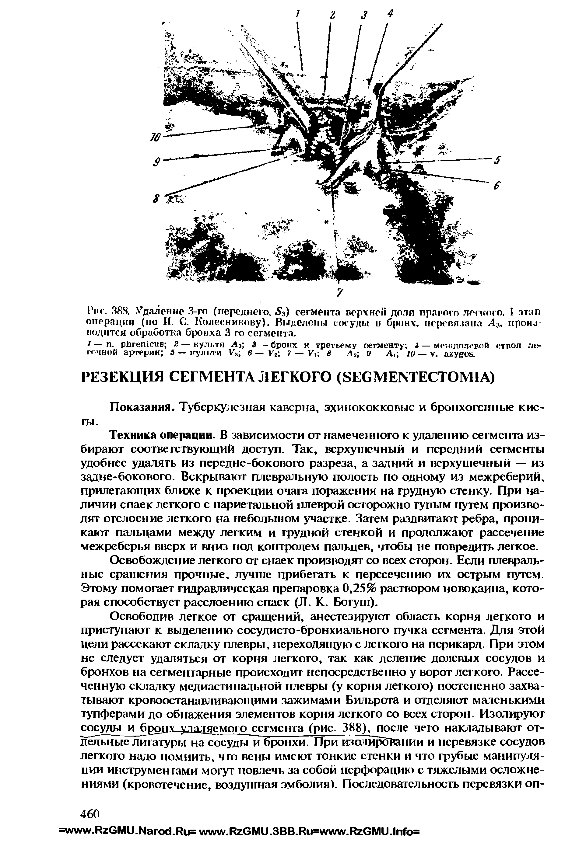 Рис. 38S. Удаление 3-го (переднего, S3) сегмента верхней доли правого легкого. I этап операции (по 11. С. Колесникову). Выделены сосуды и бронх, перевязана Л3, производится обработка бронха 3 го сегмента.