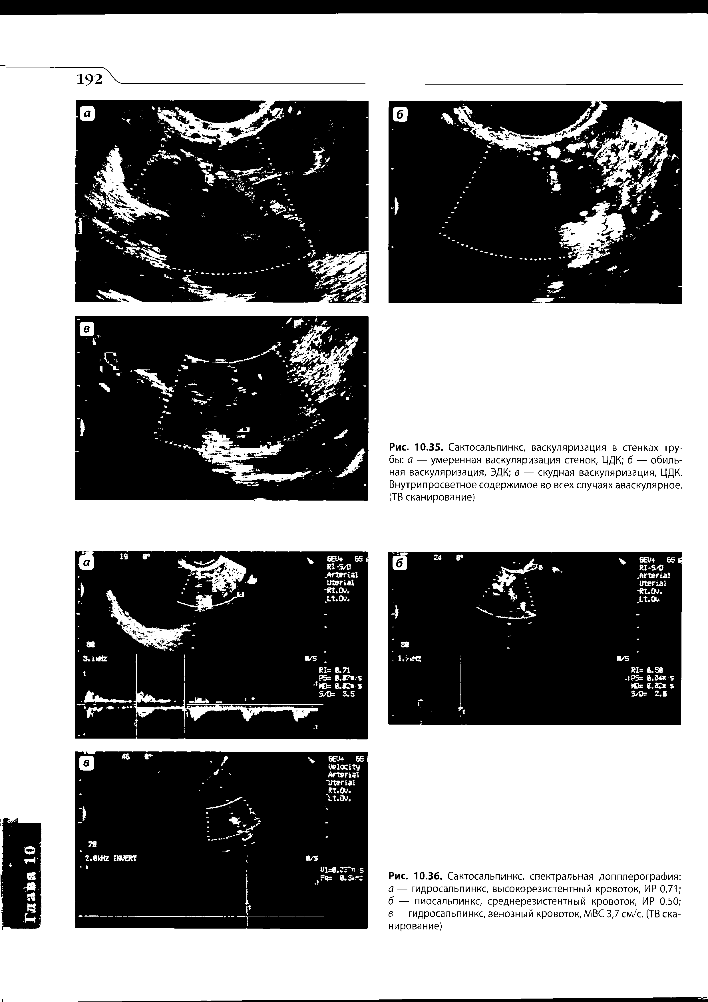 Рис. 10.35. Сактосальпинкс, васкуляризация в стенках трубы а — умеренная васкуляризация стенок, ЦДК б — обильная васкуляризация, ЭДК е — скудная васкуляризация, ЦДК. Внутрипросветное содержимое во всех случаях аваскулярное. (ТВ сканирование)...