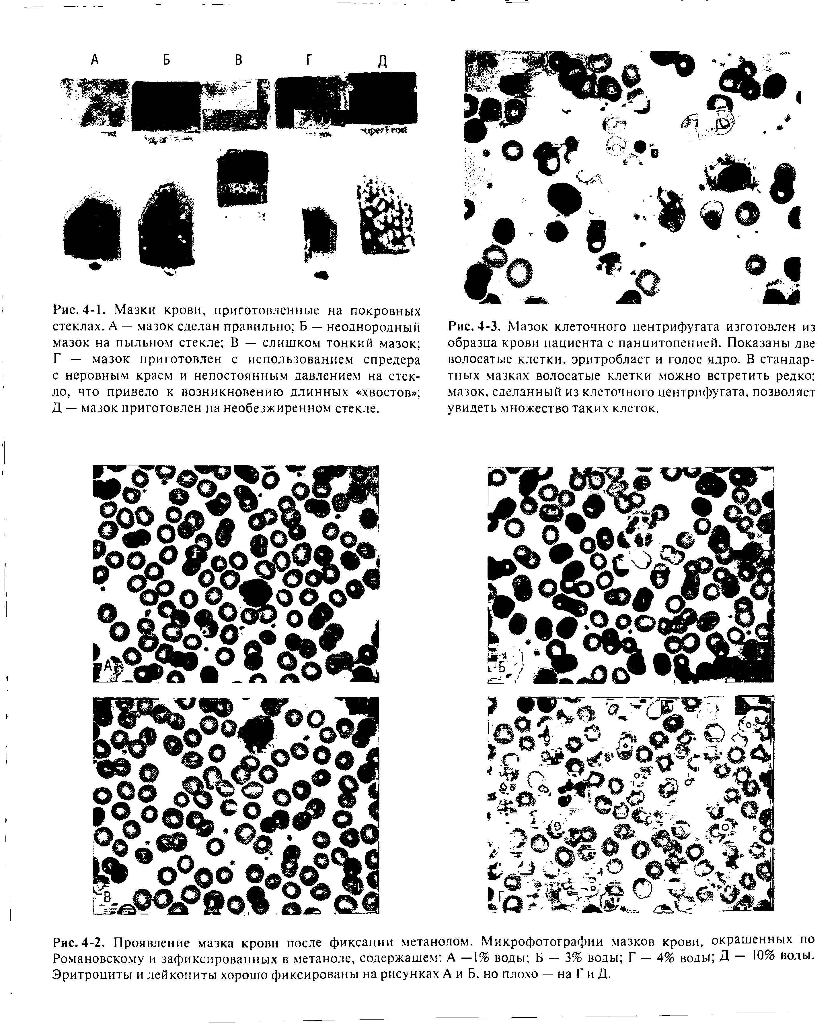 Рис. 4-2. Проявление мазка крови после фиксации метанолом. Микрофотографии мазков крови, окрашенных по Романовскому и зафиксированных в метаноле, содержащем А —1% воды Б — 3% воды Г — 4% воды Д — воды. Эритроциты и лейкоциты хорошо фиксированы на рисунках А и Б, но плохо — на Г и Д.