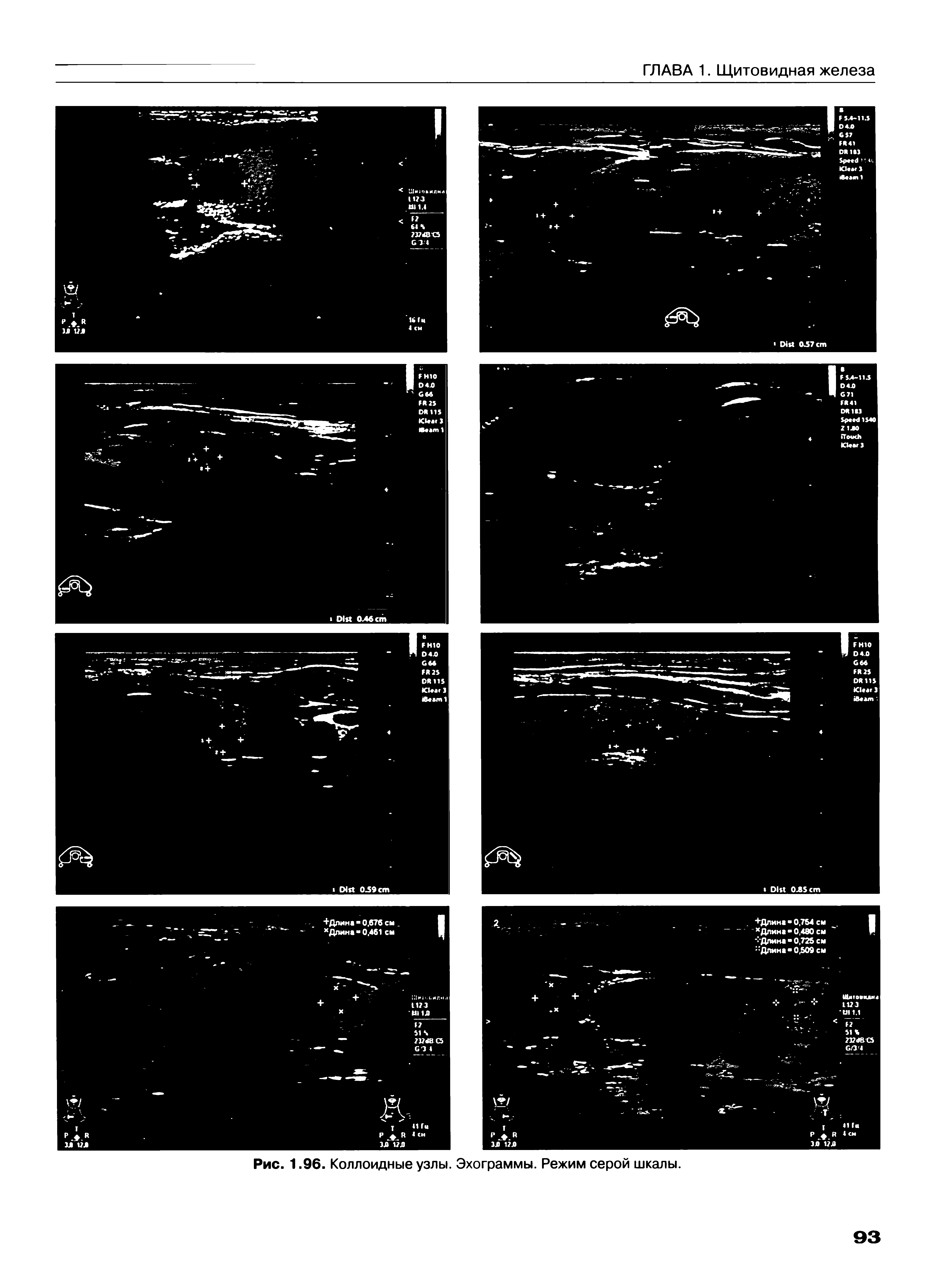 Рис. 1.96. Коллоидные узлы. Эхограммы. Режим серой шкалы.