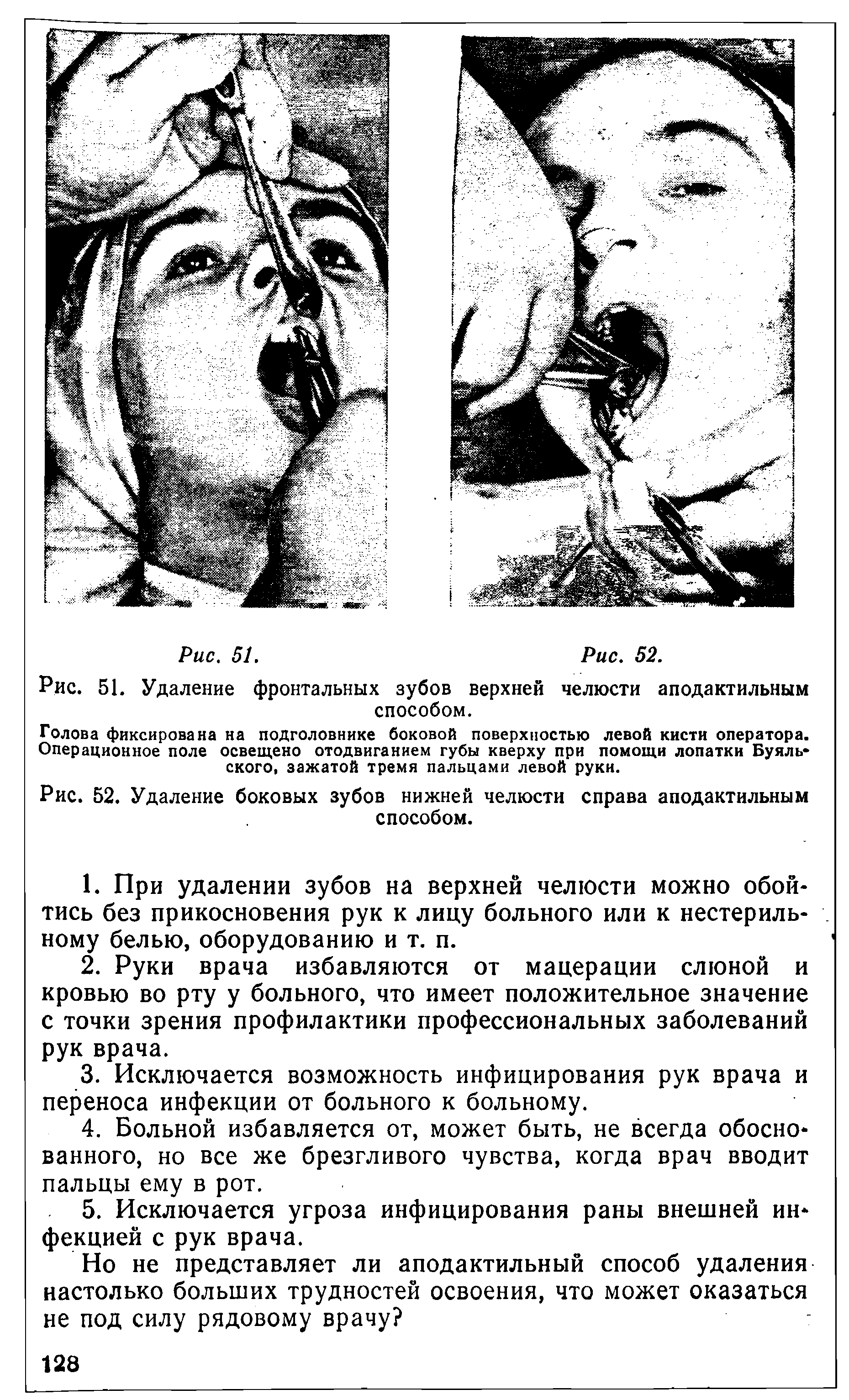 Рис. 52. Удаление боковых зубов нижней челюсти справа аподактильным способом.