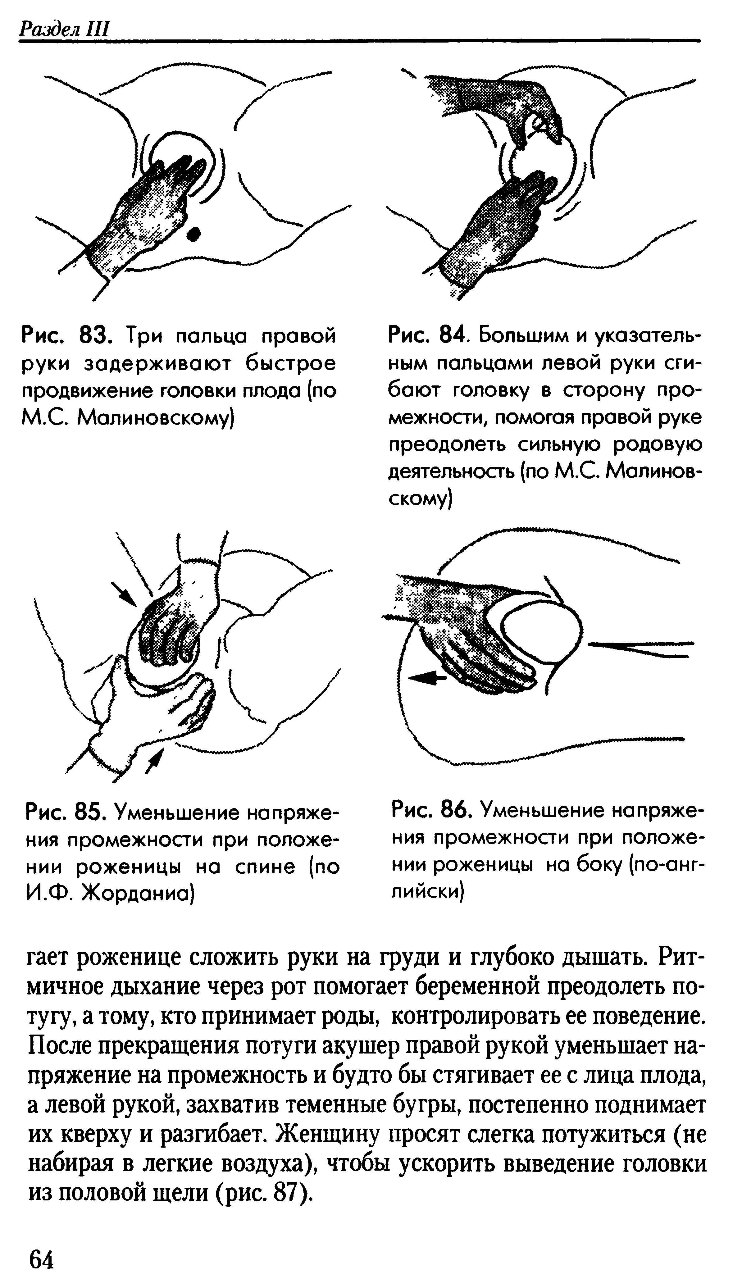 Рис. 86. Уменьшение напряжения промежности при положении роженицы на боку (по-английски)...