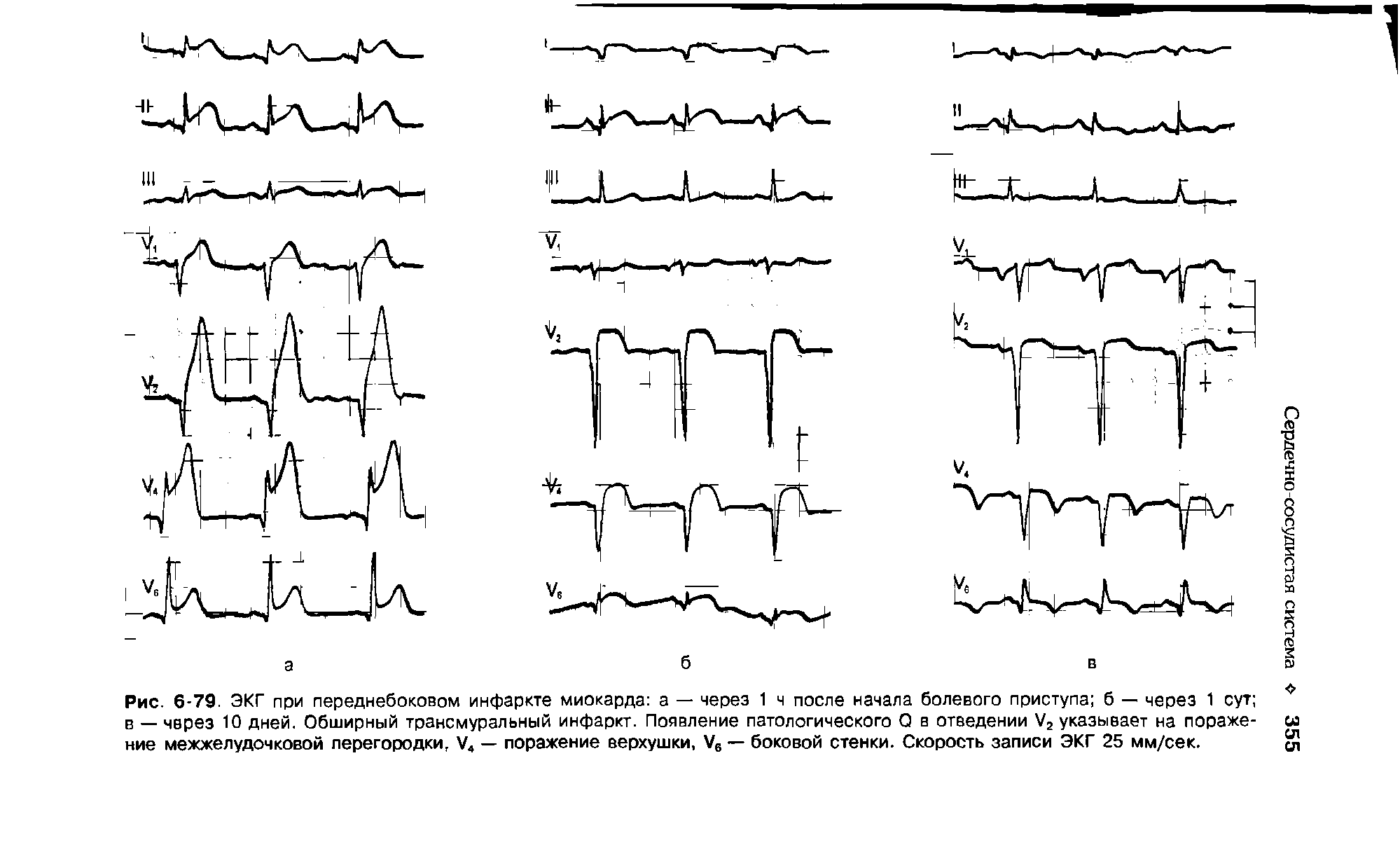 Рис. 6-79. ЭКГ при переднебоковом инфаркте миокарда а — через 1 ч после начала болевого приступа б — через 1 сут в через 10 дней. Обширный трансмуральный инфаркт. Появление патологического О в отведении У2 указывает на пораже- со ние межжелудочковой перегородки, У4 — поражение верхушки, У6 — боковой стенки. Скорость записи ЭКГ 25 мм/сек. ...