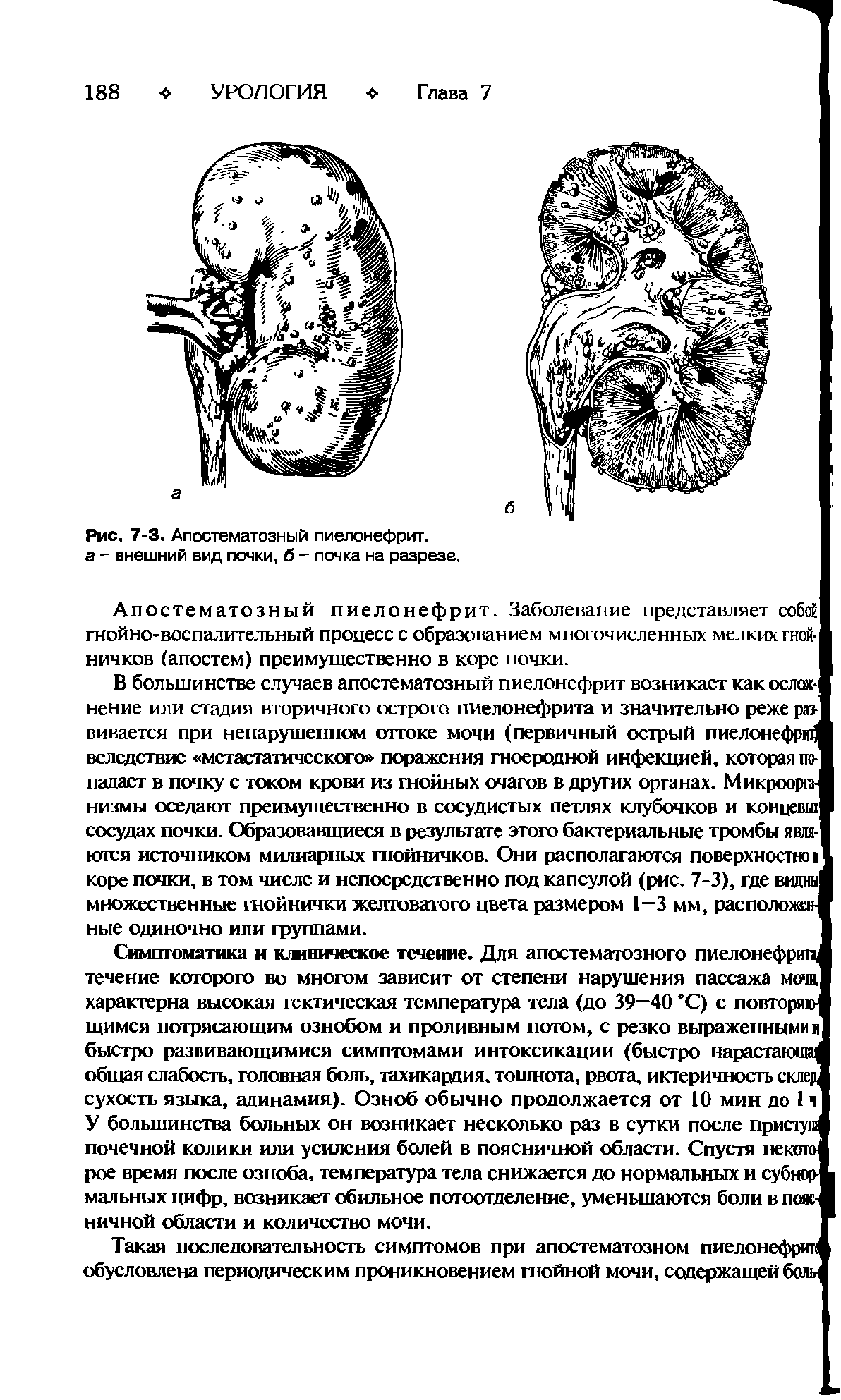 Рис. 7-3. Апостематозный пиелонефрит, а - внешний вид почки, б - почка на разрезе.