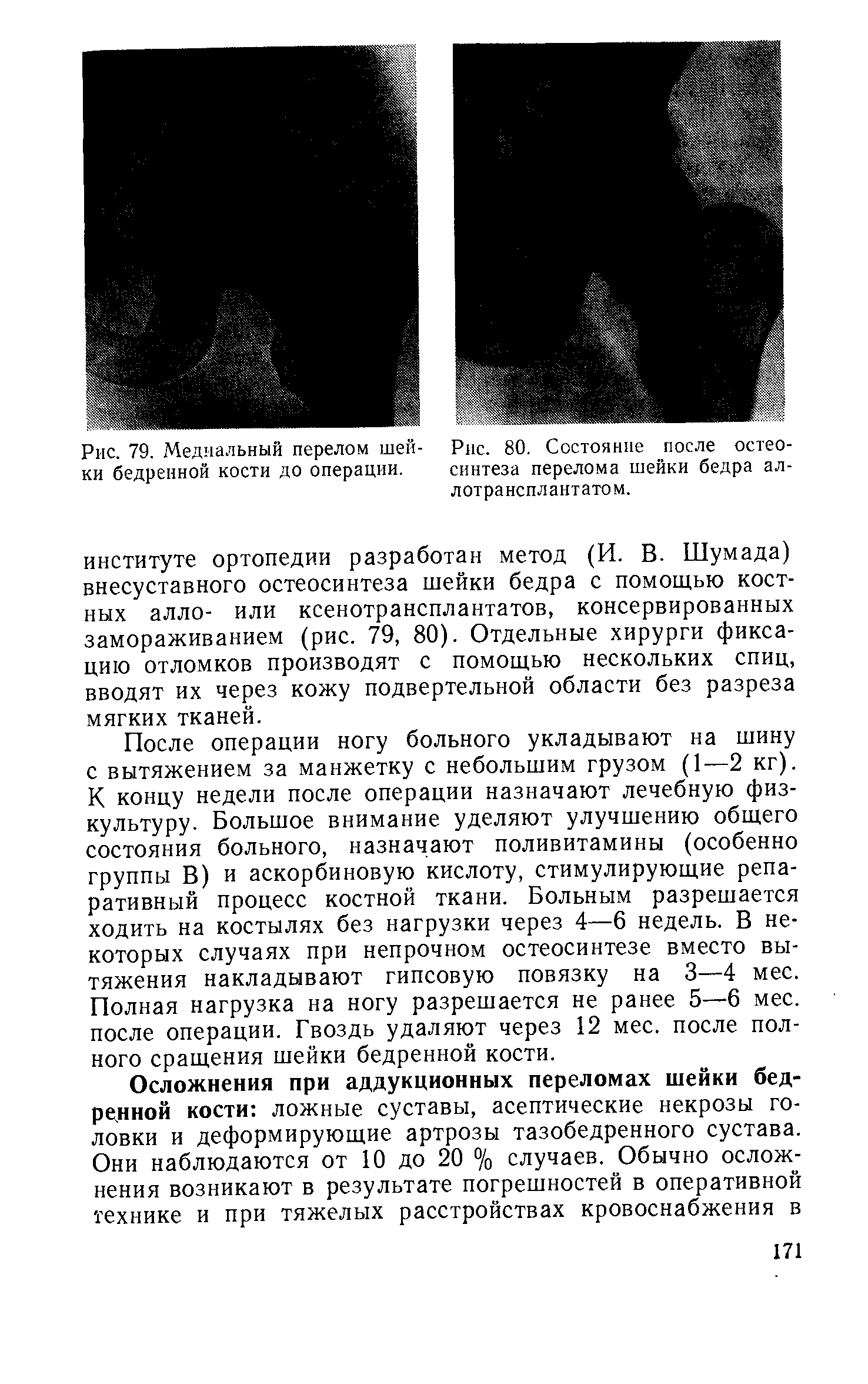 Рис. 80. Состояние после остео, синтеза перелома шейки бедра ад. лотрансплантатом.