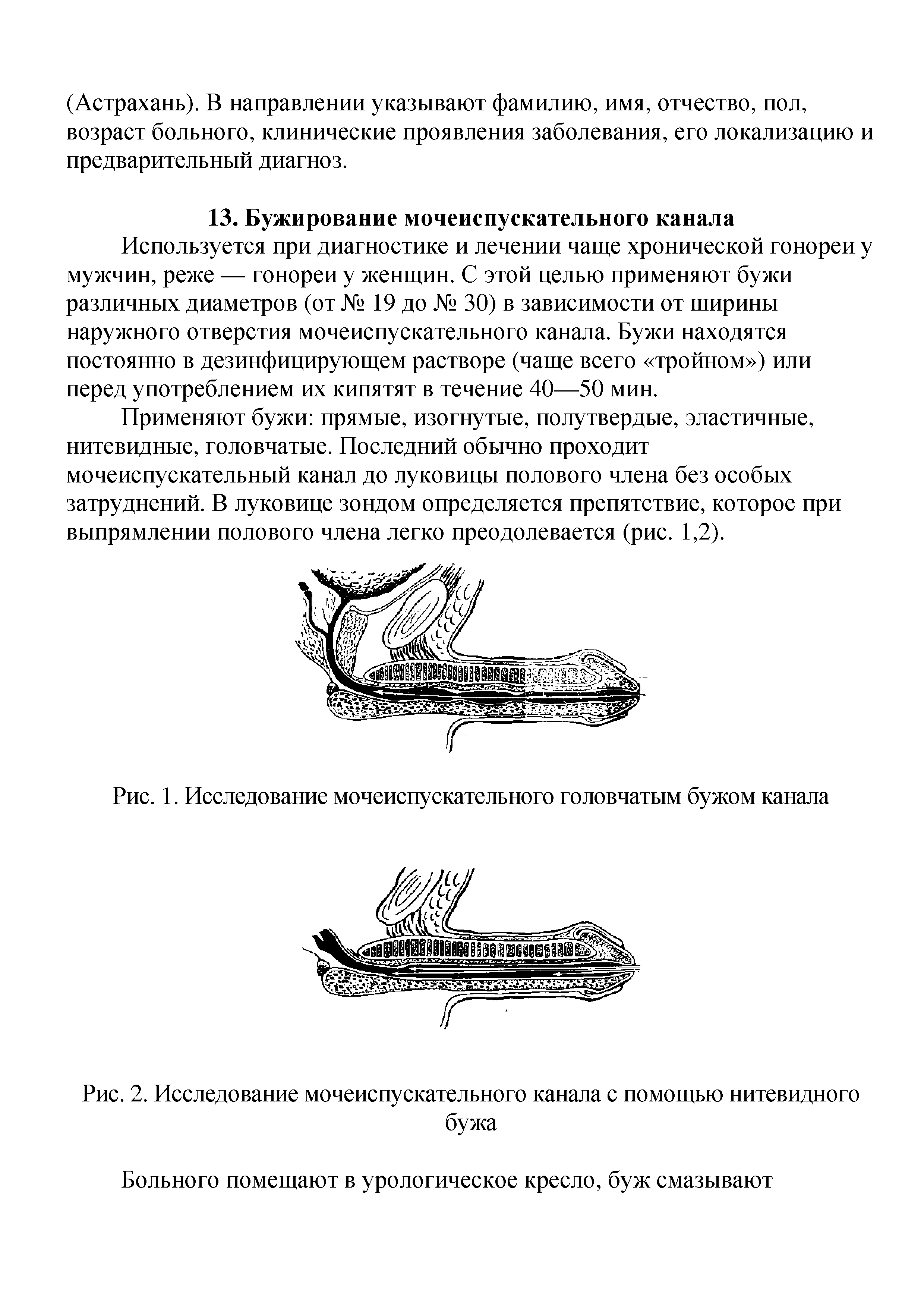 Рис. 2. Исследование мочеиспускательного канала с помощью нитевидного бужа...