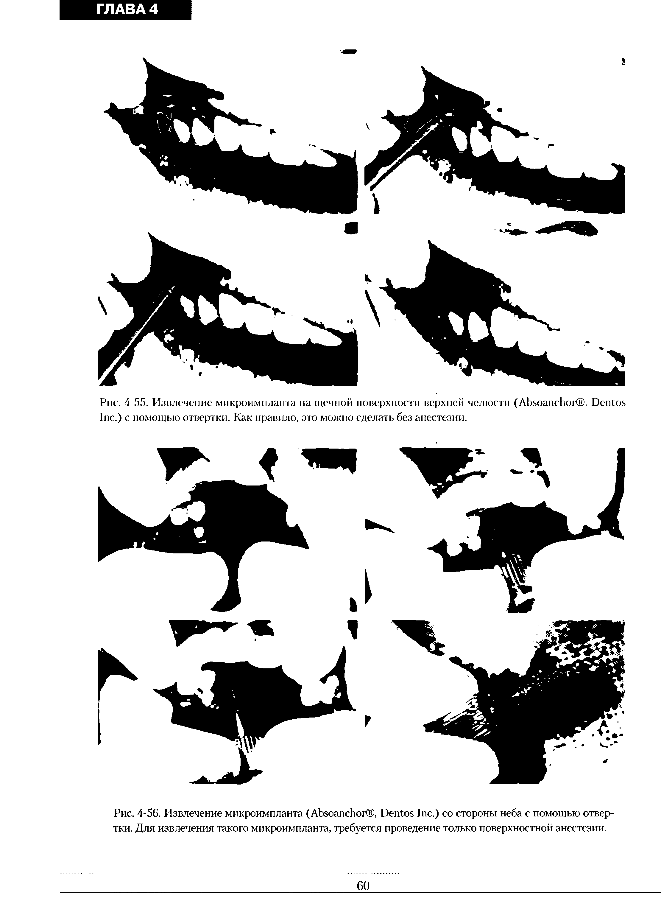 Рис. 4-56. Извлечение микроимпланта (A , D I .) со стороны неба с помощью отвертки. Для извлечения такого микроимпланта, требуется проведение только поверхностной анестезии.