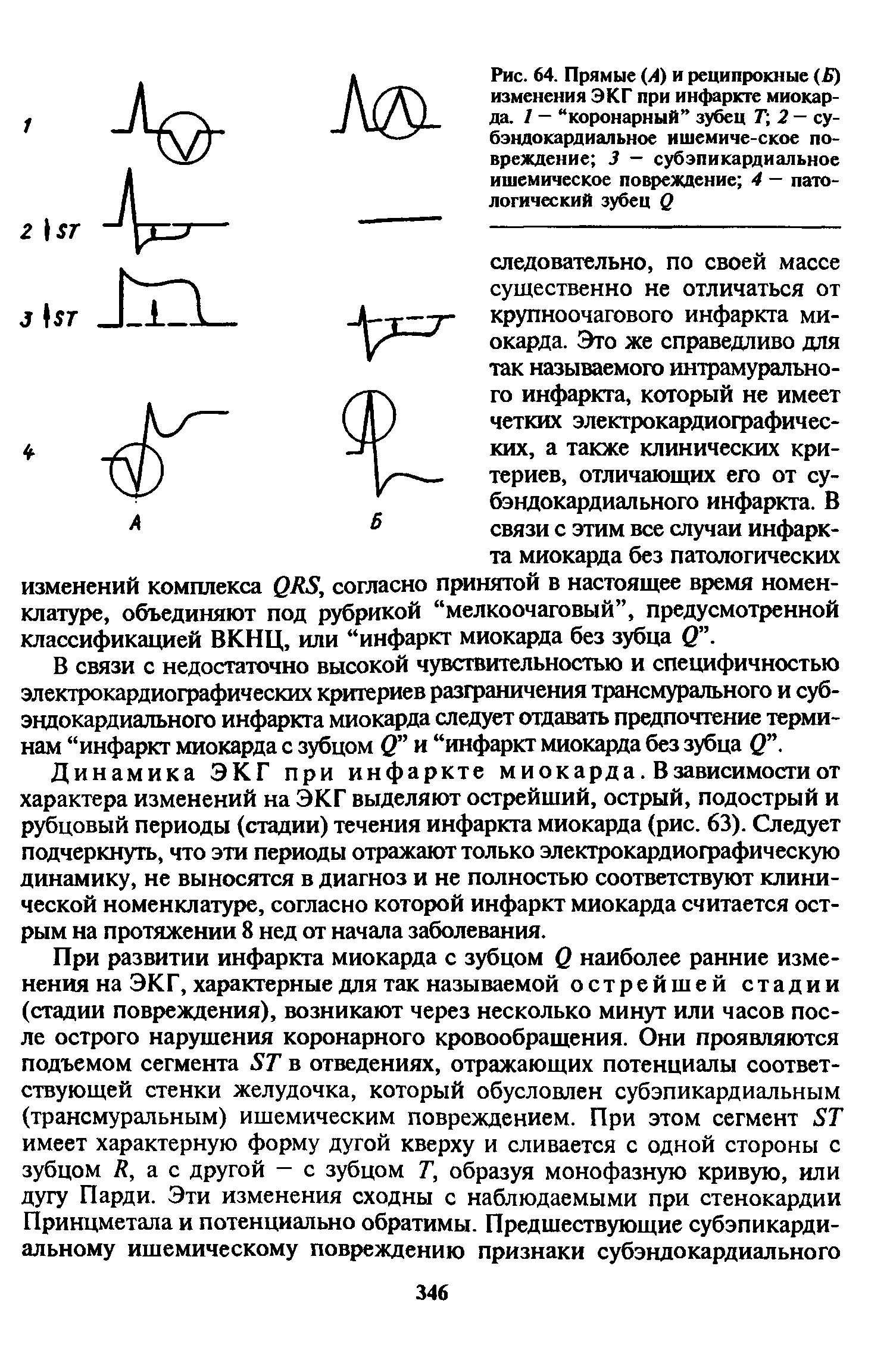 Рис. 64. Прямые (4) и реципрокные ( ) изменения ЭКГ при инфаркте миокарда. 7 - коронарный зубец Т 2 - субэндокардиальное ишемиче-ское повреждение 3 — субэпикардиальное ишемическое повреждение 4 — патологический зубец О...