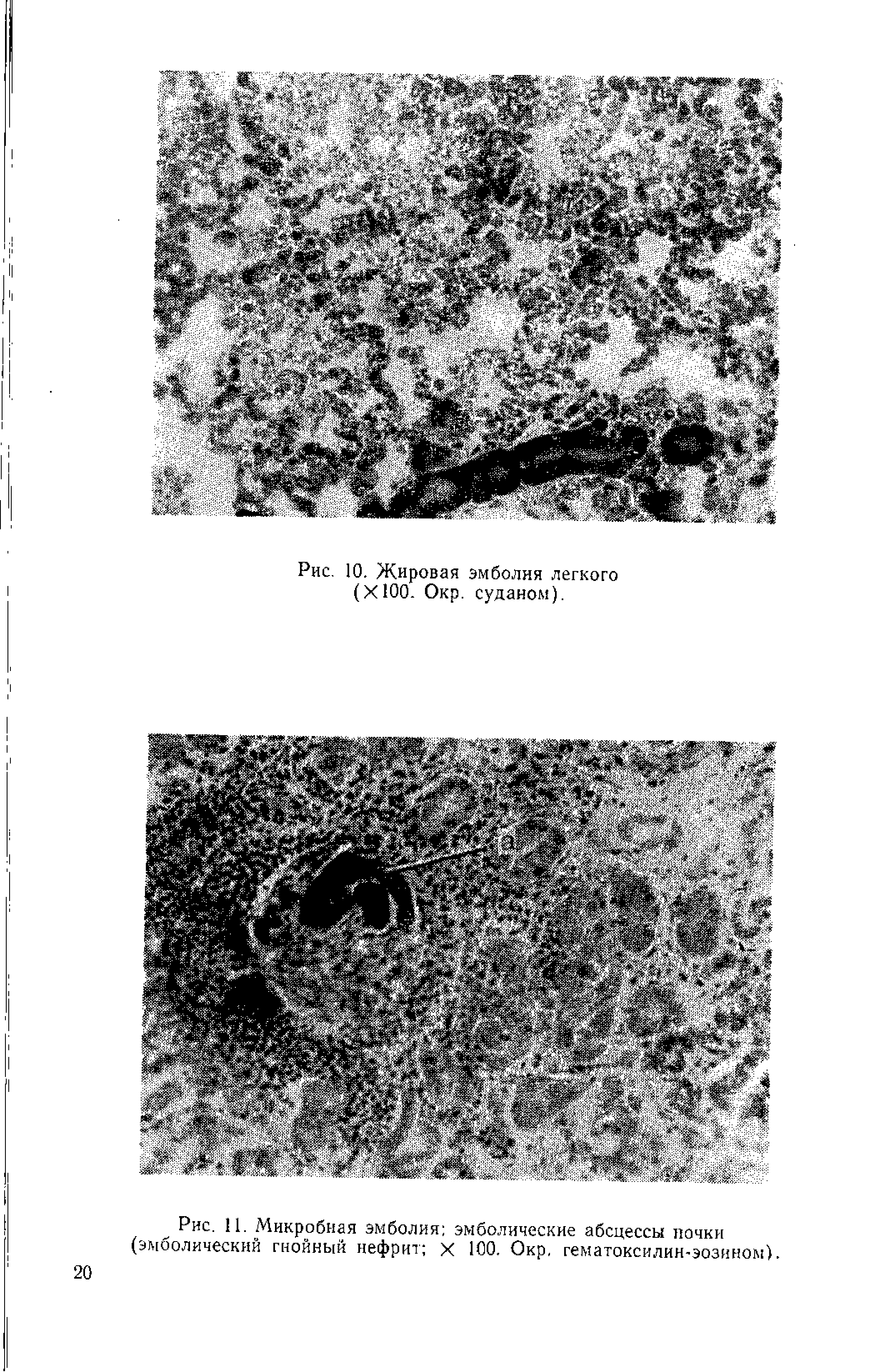 Рис. 11. Микробная эмболия эмболические абсцессы почки (эмоолический гнойный нефрит х 100. Окр. гематоксилин-эознном).