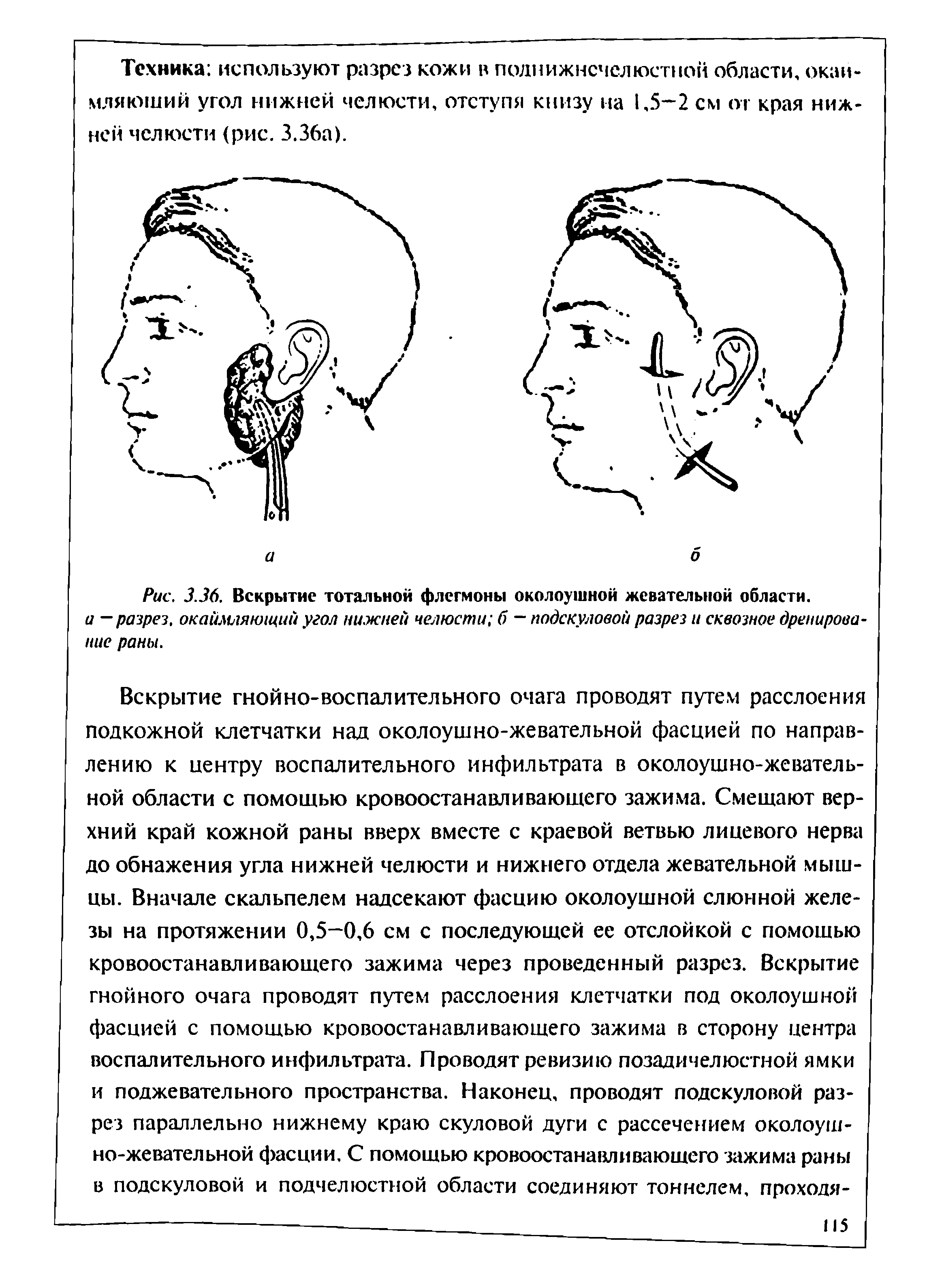 Рис. 3.36. Вскрытие тотальной флегмоны околоушной жевательной области. а — разрез, окаймляющий угол нижней челюсти б — подскуловой разрез и сквозное дренирование раны.