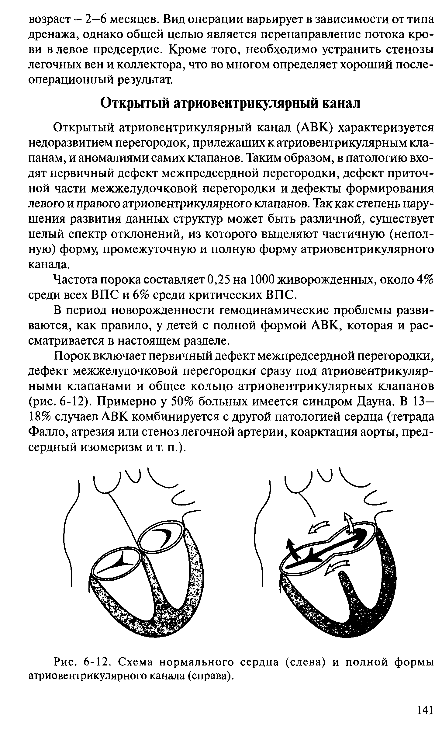 Рис. 6-12. Схема нормального сердца (слева) и полной формы атриовентрикулярного канала (справа).