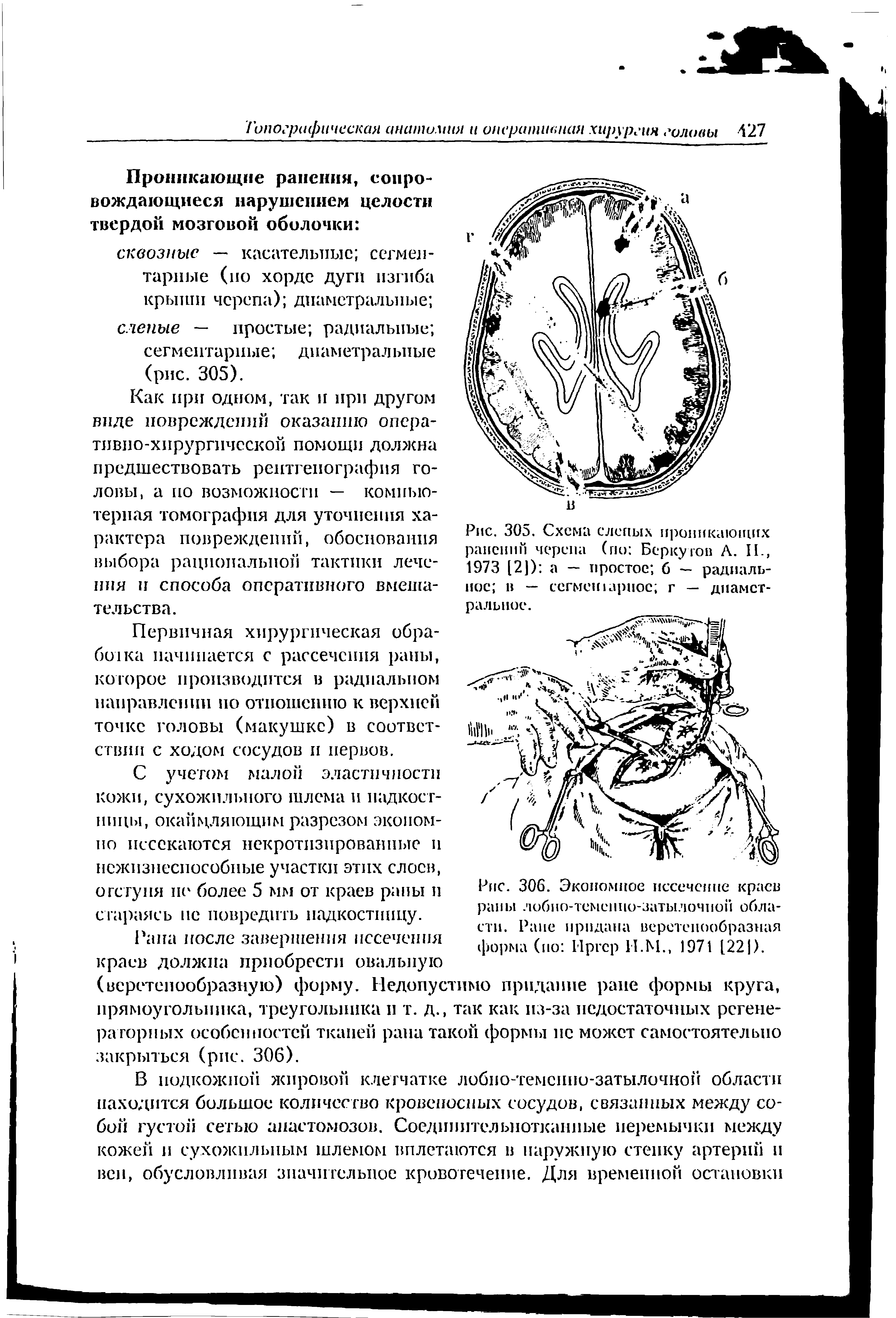 Рис. 306. Экономное иссечение краев раны лобио-теменно-затылочной области. Райе придана веретенообразная форма (по Нргср Н.М., 1971 [221).