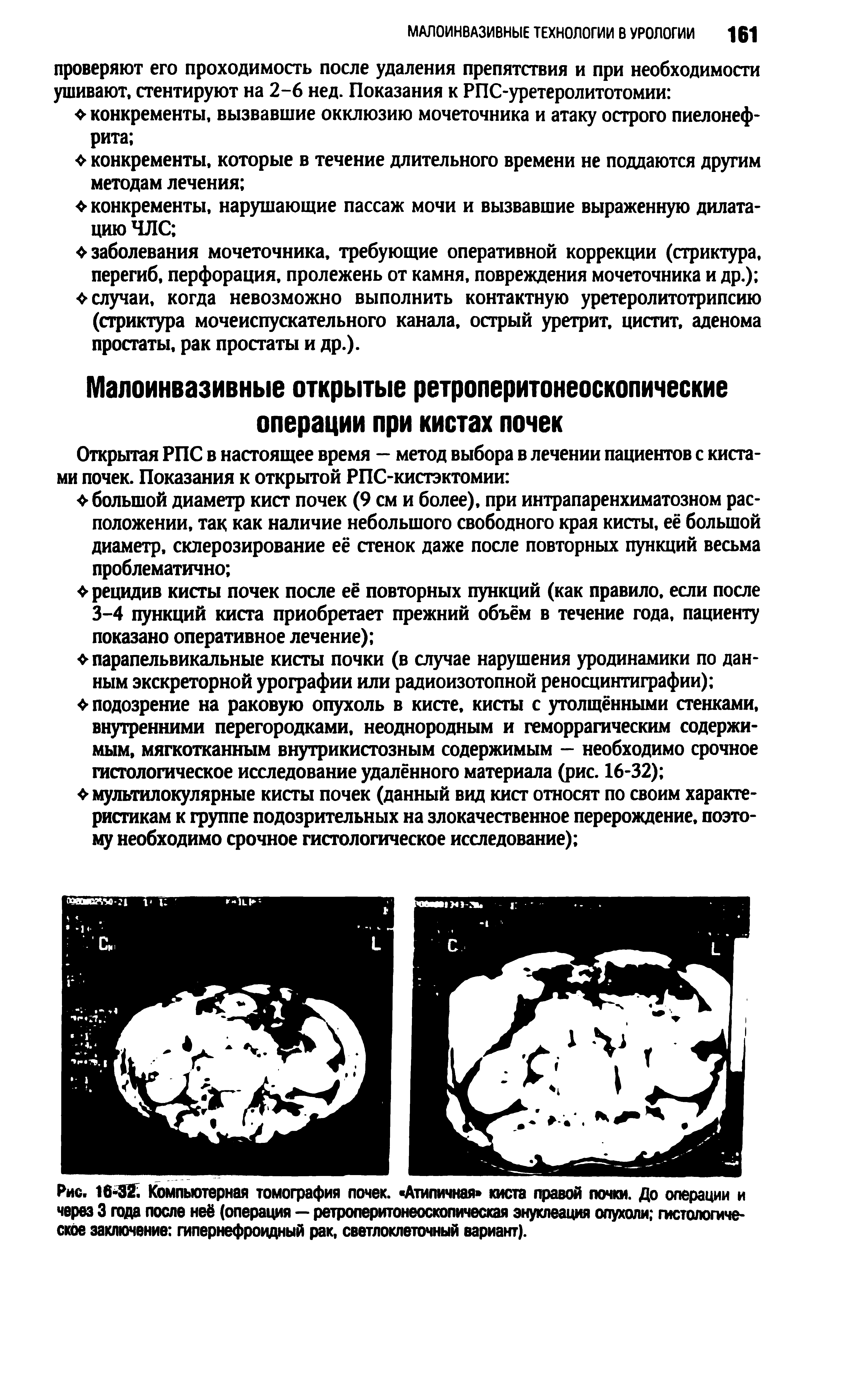 Рис. 16-32. Компьютерная томография почек. Атипичная киста правой почки. До операции и через 3 года после неё (операция — ретроперитонеоскопическая энуклеация опухоли гистологическое заключение гипернефроидный рак, светлоклеточный вариант).