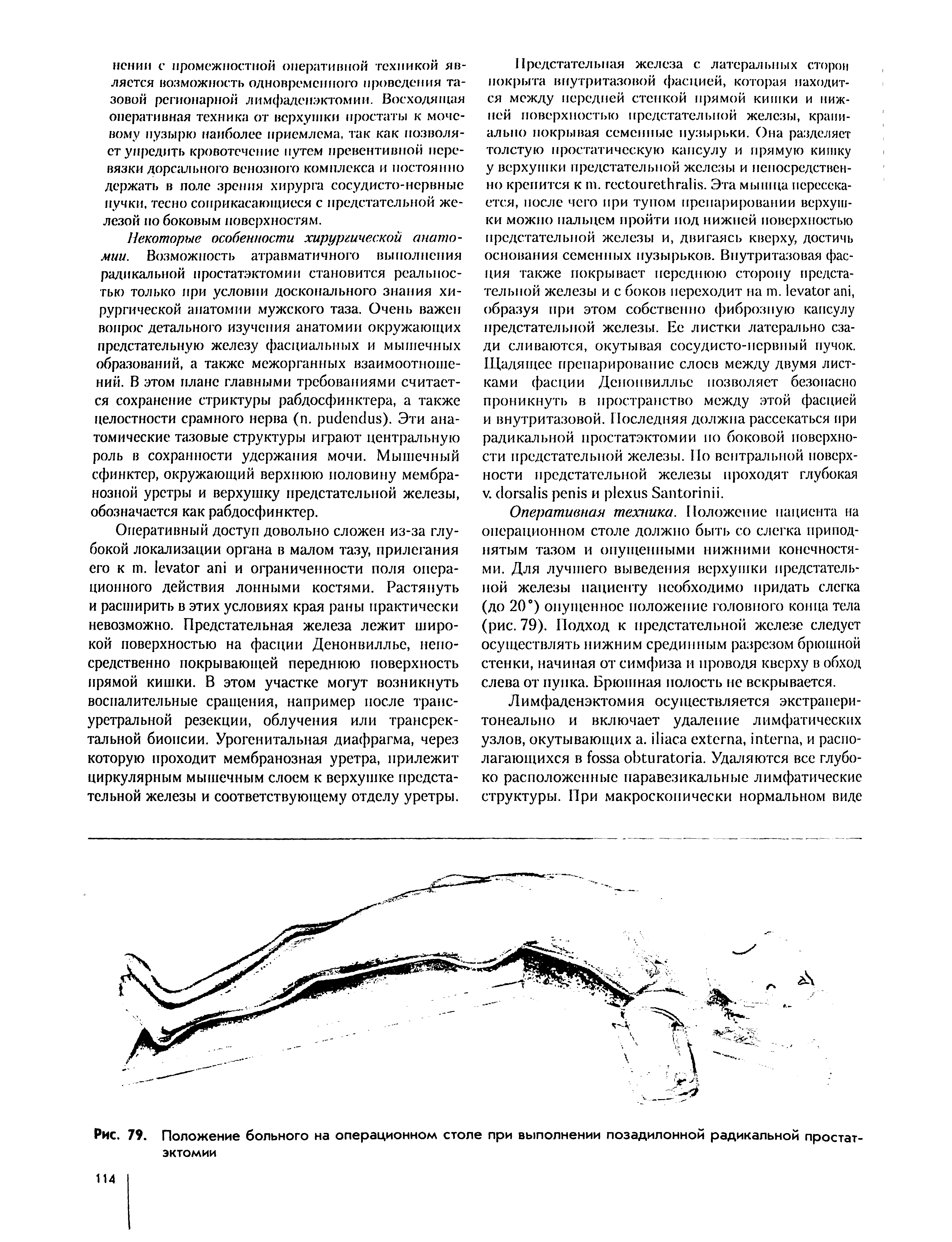 Рис. 79. Положение больного на операционном столе при выполнении позадилонной радикальной простатэктомии...