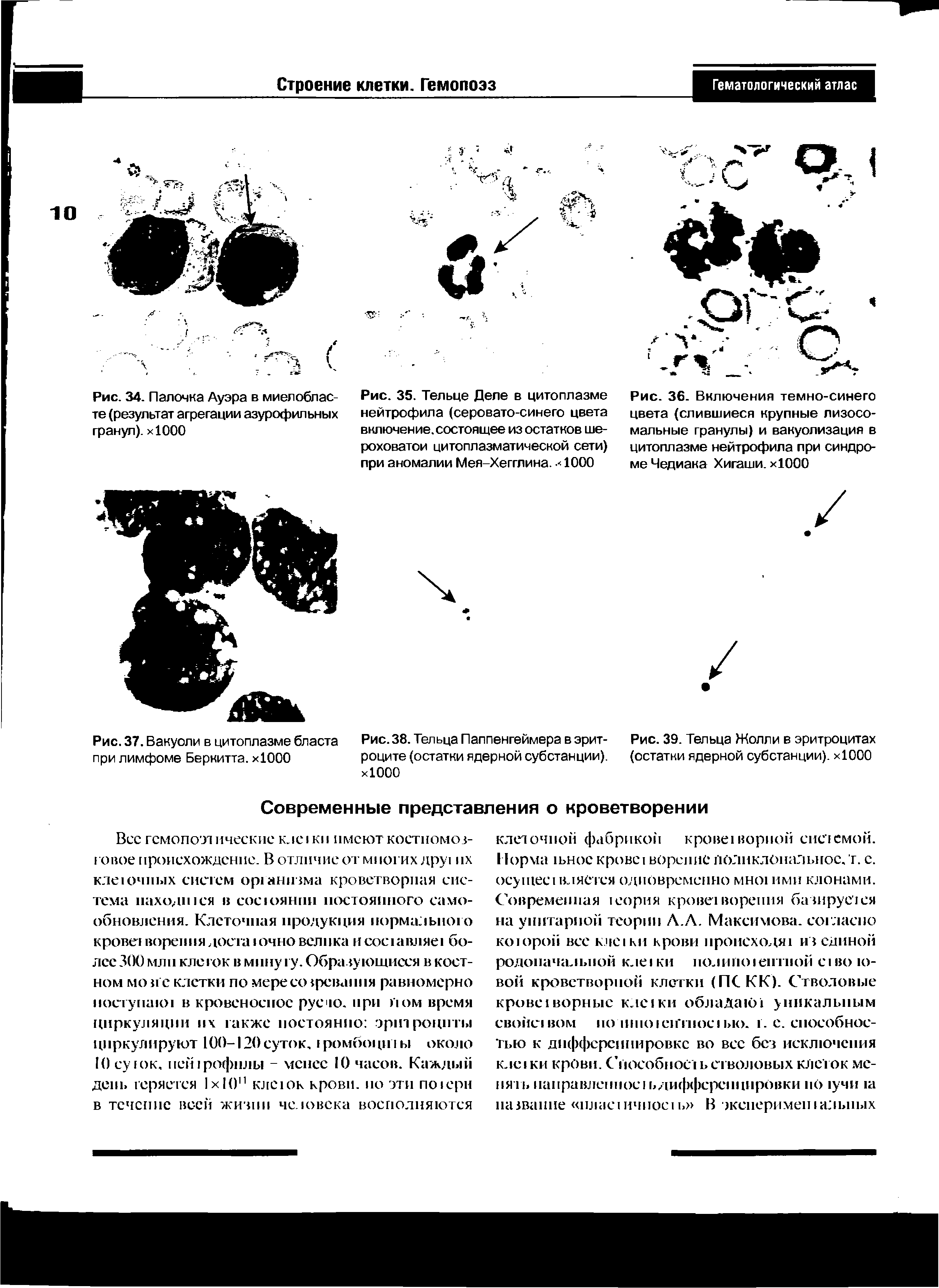 Рис. 36. Включения темно-синего цвета (слившиеся крупные лизосомальные гранулы) и вакуолизация в цитоплазме нейтрофила при синдроме Чедиака Хигаши. хЮОО...