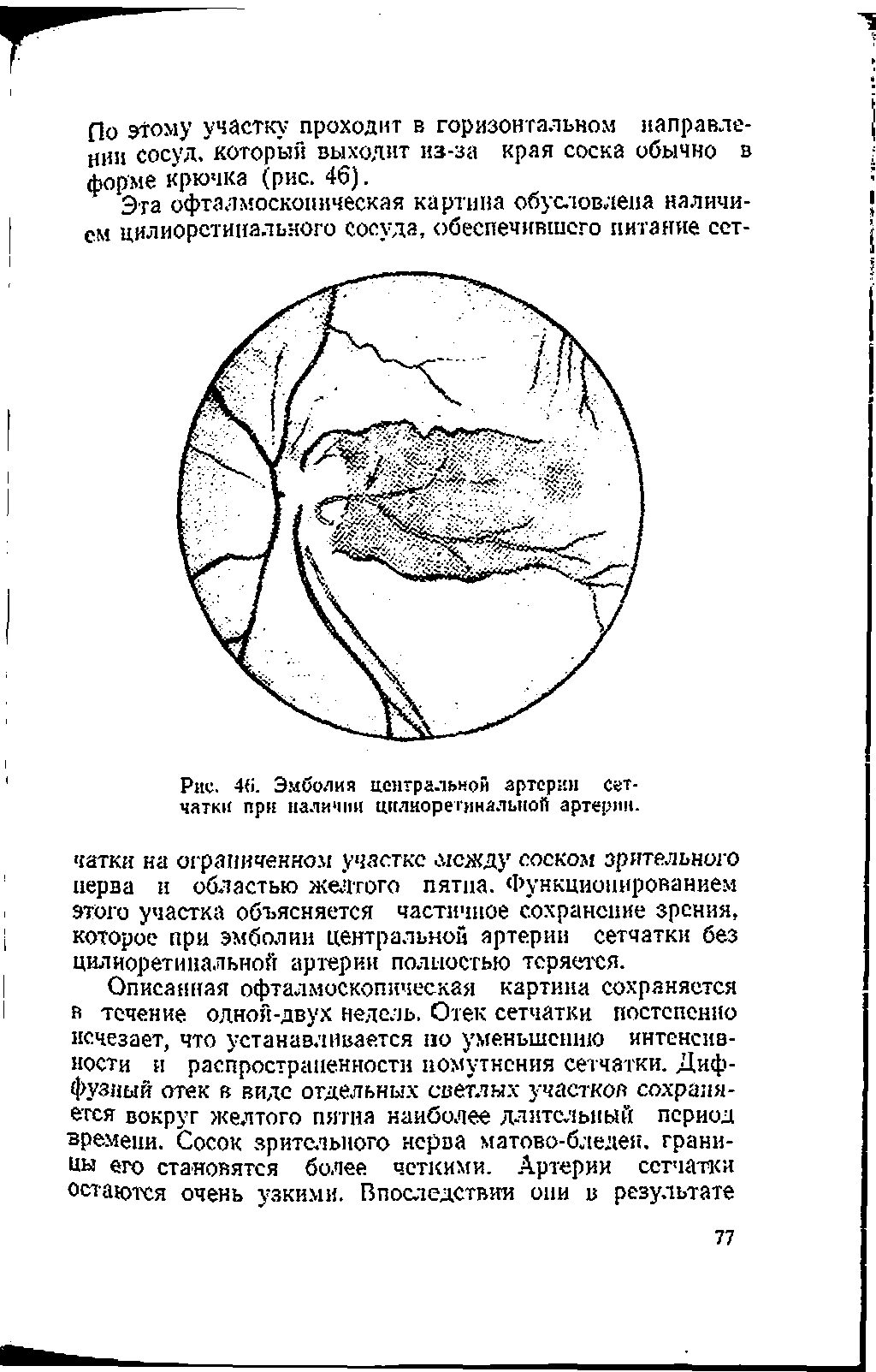 Рис. 46. Эмболия центральной артерии сетчатки при наличии цилиорегмналыюй артерии-...