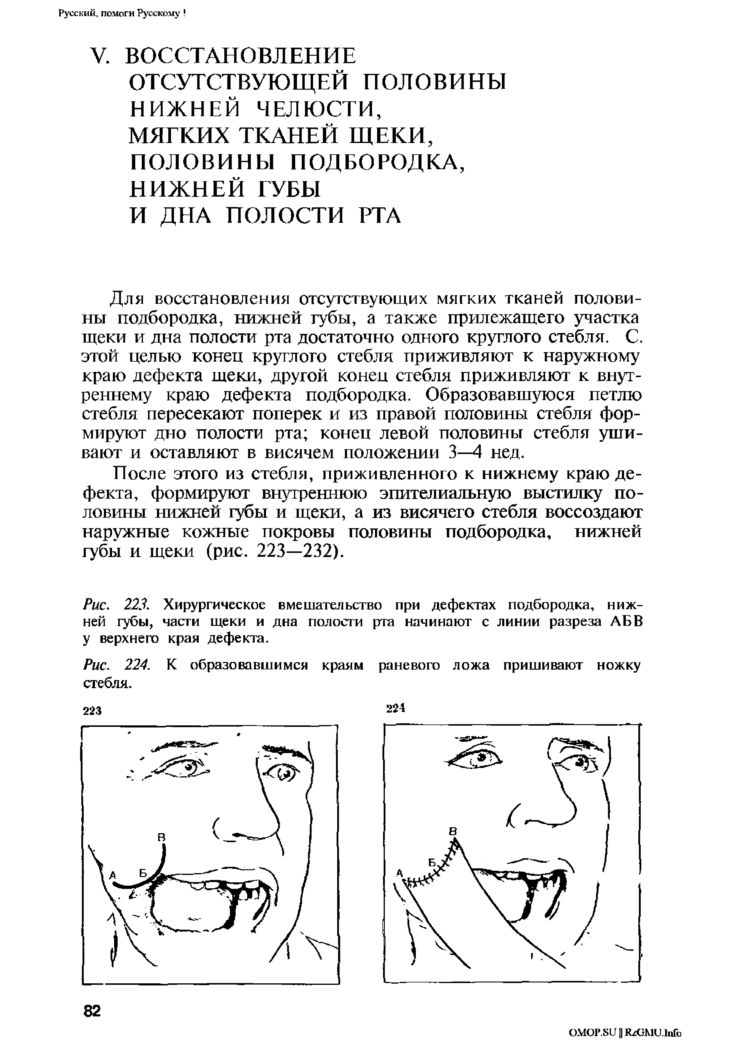 Рис. 223. Хирургическое вмешательство при дефектах подбородка, нижней губы, части щеки и дна полости рта начинают с линии разреза АБВ у верхнего края дефекта.