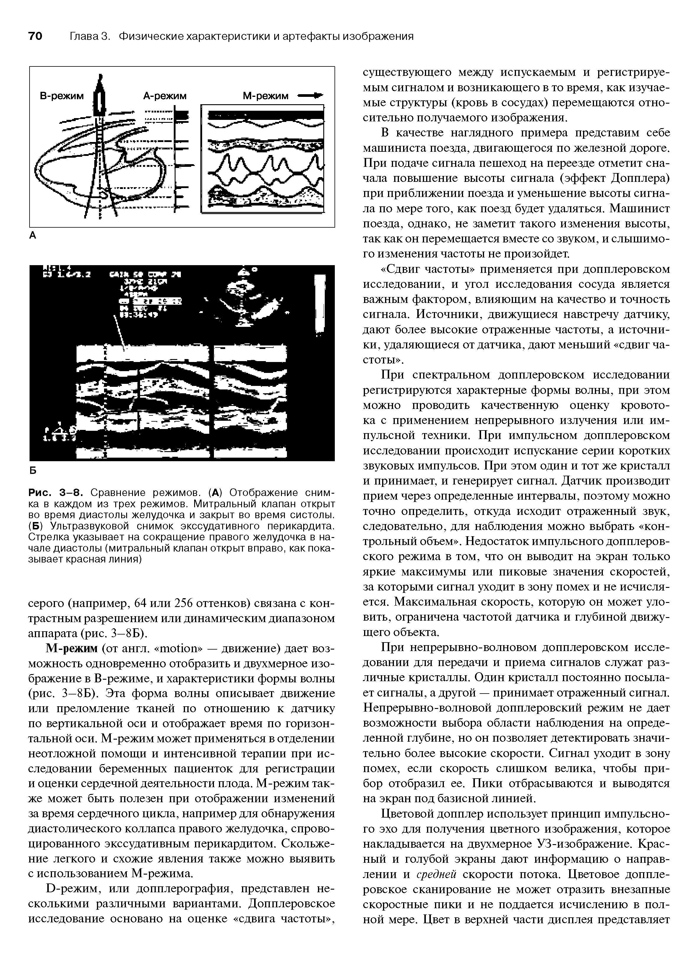Рис. 3-8. Сравнение режимов. (А) Отображение снимка в каждом из трех режимов. Митральный клапан открыт во время диастолы желудочка и закрыт во время систолы. (Б) Ультразвуковой снимок экссудативного перикардита. Стрелка указывает на сокращение правого желудочка в начале диастолы (митральный клапан открыт вправо, как показывает красная линия)...