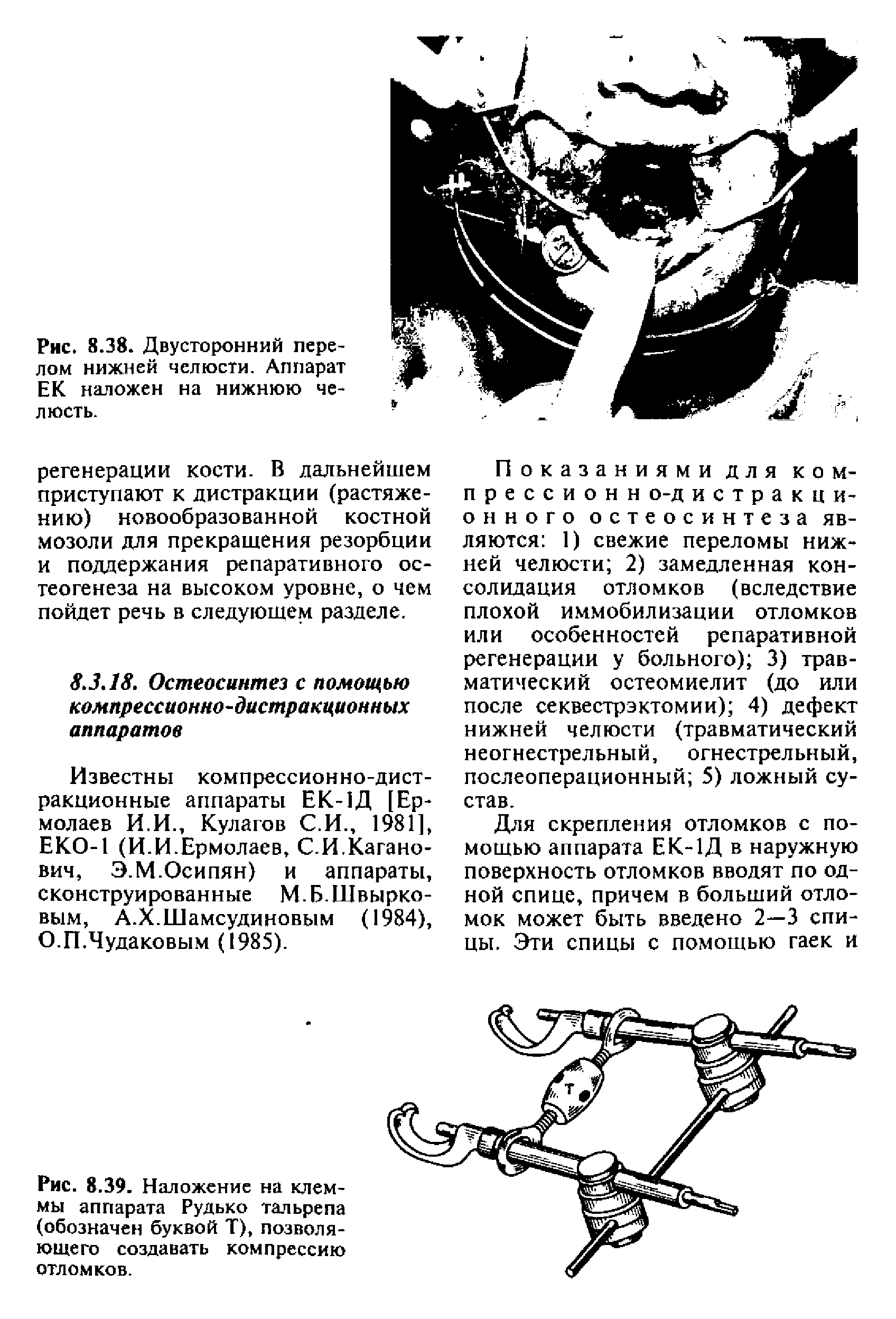 Рис. 8.39. Наложение на клеммы аппарата Рудько тальрепа (обозначен буквой Т), позволяющего создавать компрессию отломков.