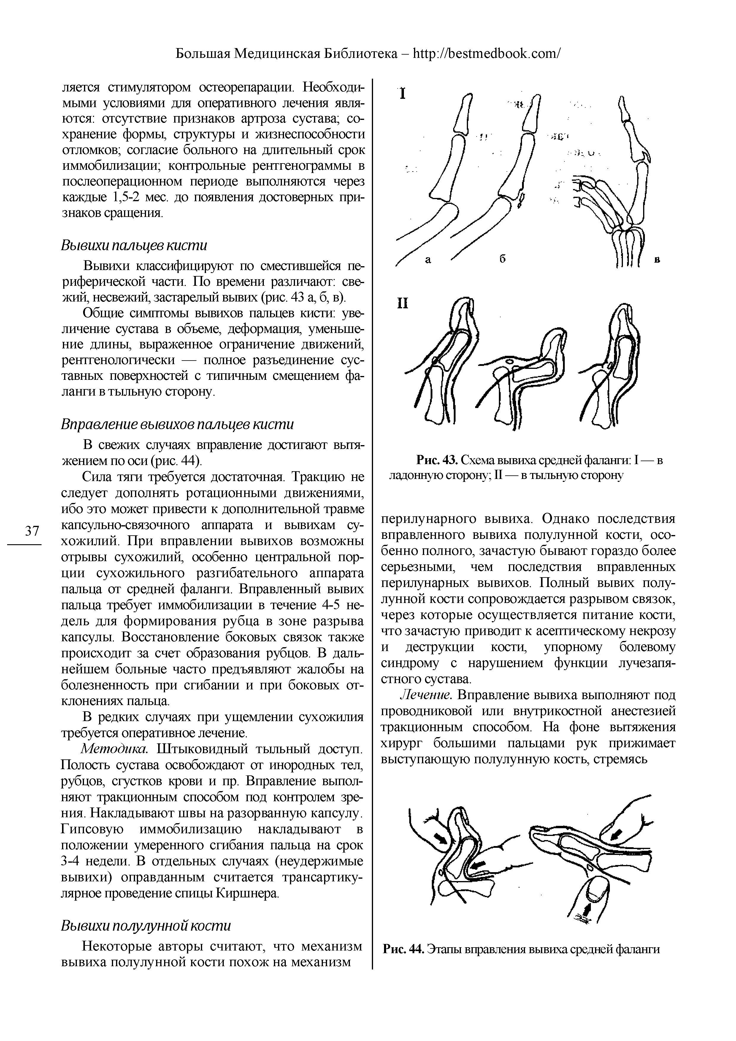 Рис. 43. Схема вывиха средней фаланги I — в ладонную сторону II — в тыльную сторону...