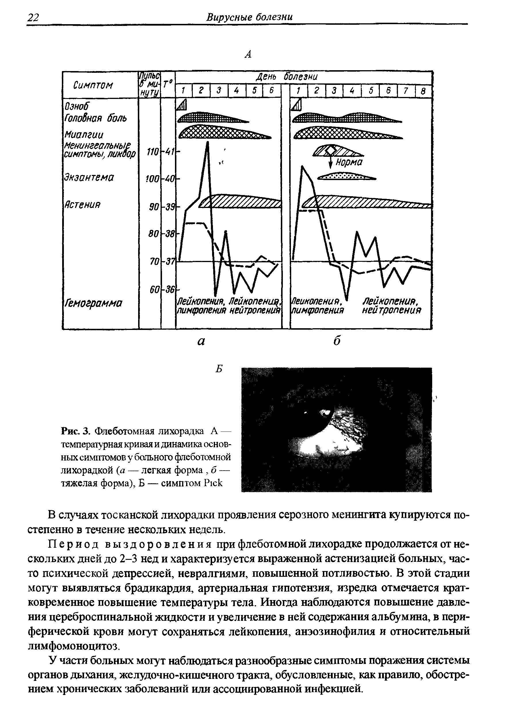 Рис. 3. Флеботомная лихорадка А — температурная кривая и динамика основных симптомов у больного флеботомной лихорадкой (а — легкая форма, б — тяжелая форма), Б — симптом P ...