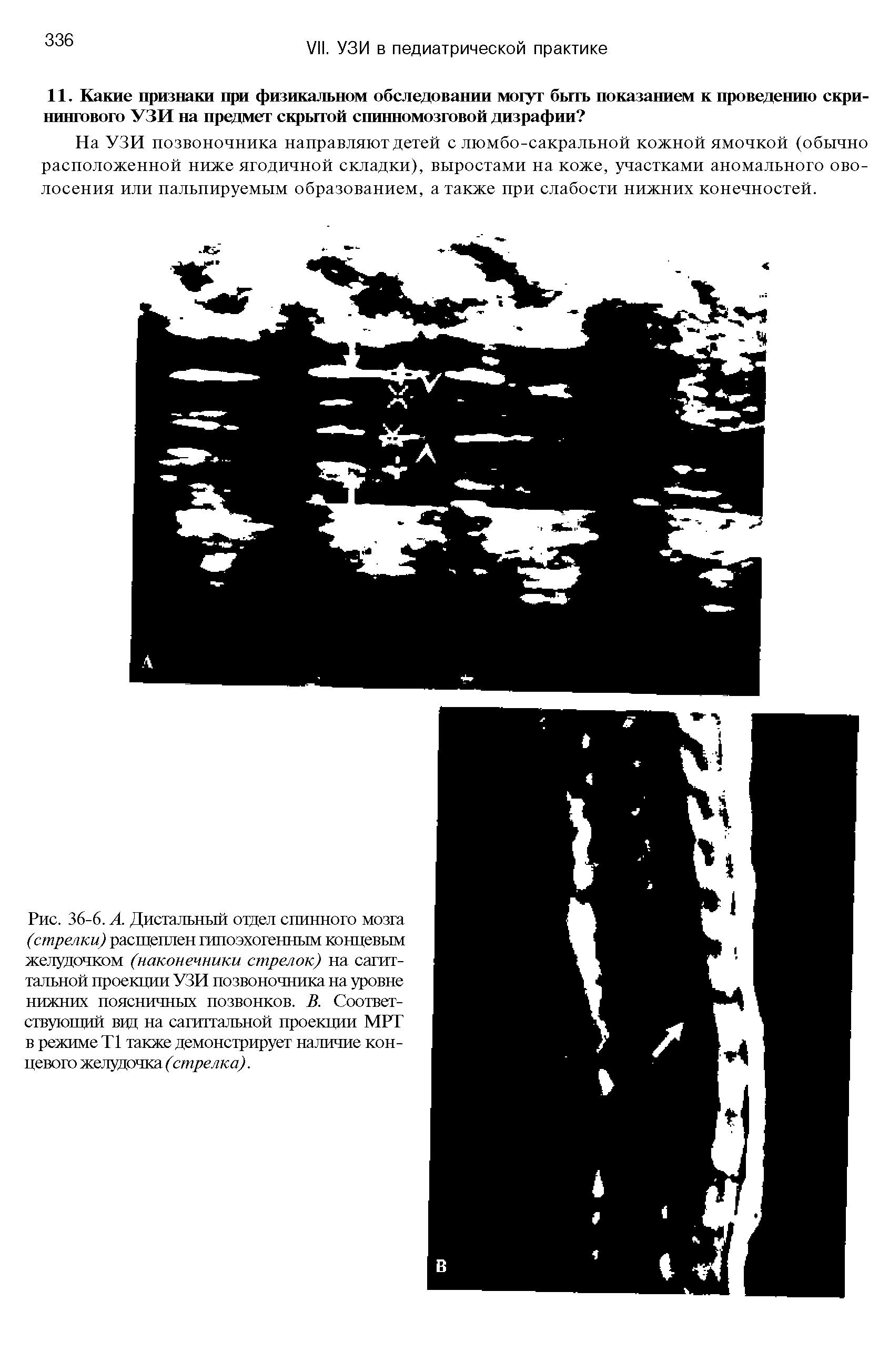 Рис. 36-6. А. Дистальный отдел спинного мозга (стрелки) расщеплен гипоэхогенным концевым желудочком (наконечники стрелок) на сагиттальной проекции УЗИ позвоночника на уровне нижних поясничных позвонков. В. Соответствующий вцд на сагиттальной проекции МРТ в режиме Т1 также демонстрирует наличие концевого желудочка (стрелка).