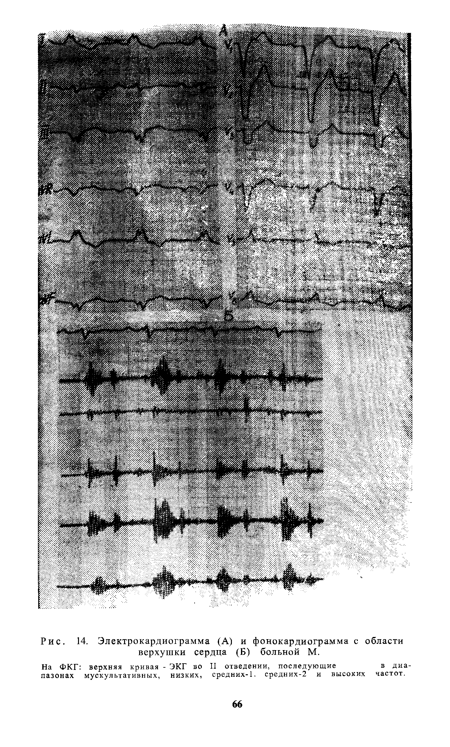 Рис. 14. Электрокардиограмма (А) и фонокардиограмма с области верхушки сердца (Б) больной М.