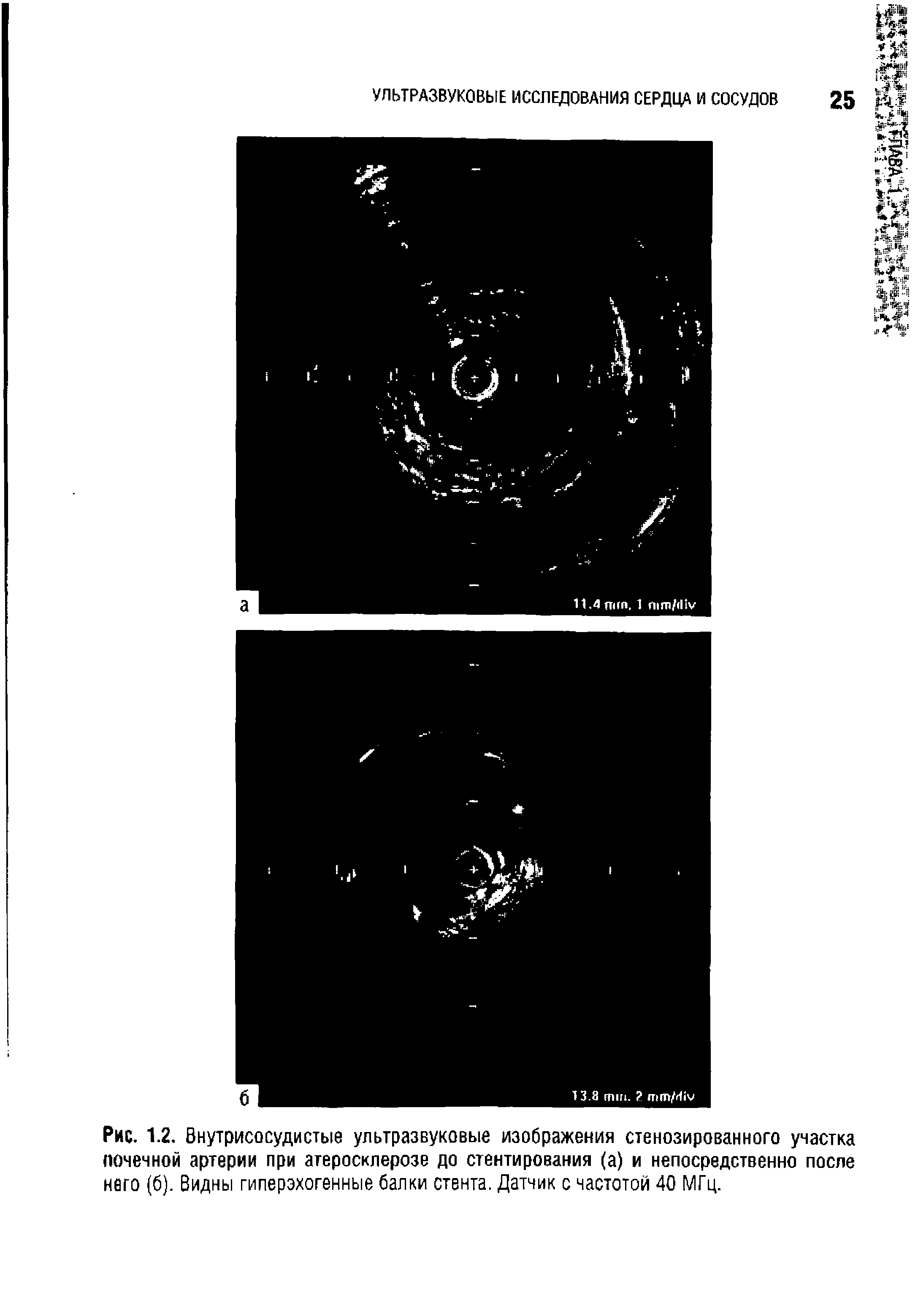 Рис. 1.2. Внутрисосудистые ультразвуковые изображения стенозированного участка почечной артерии при атеросклерозе до стентирования (а) и непосредственно после него (6). Видны гиперэхогенные балки стента. Датчик с частотой 40 МГц.