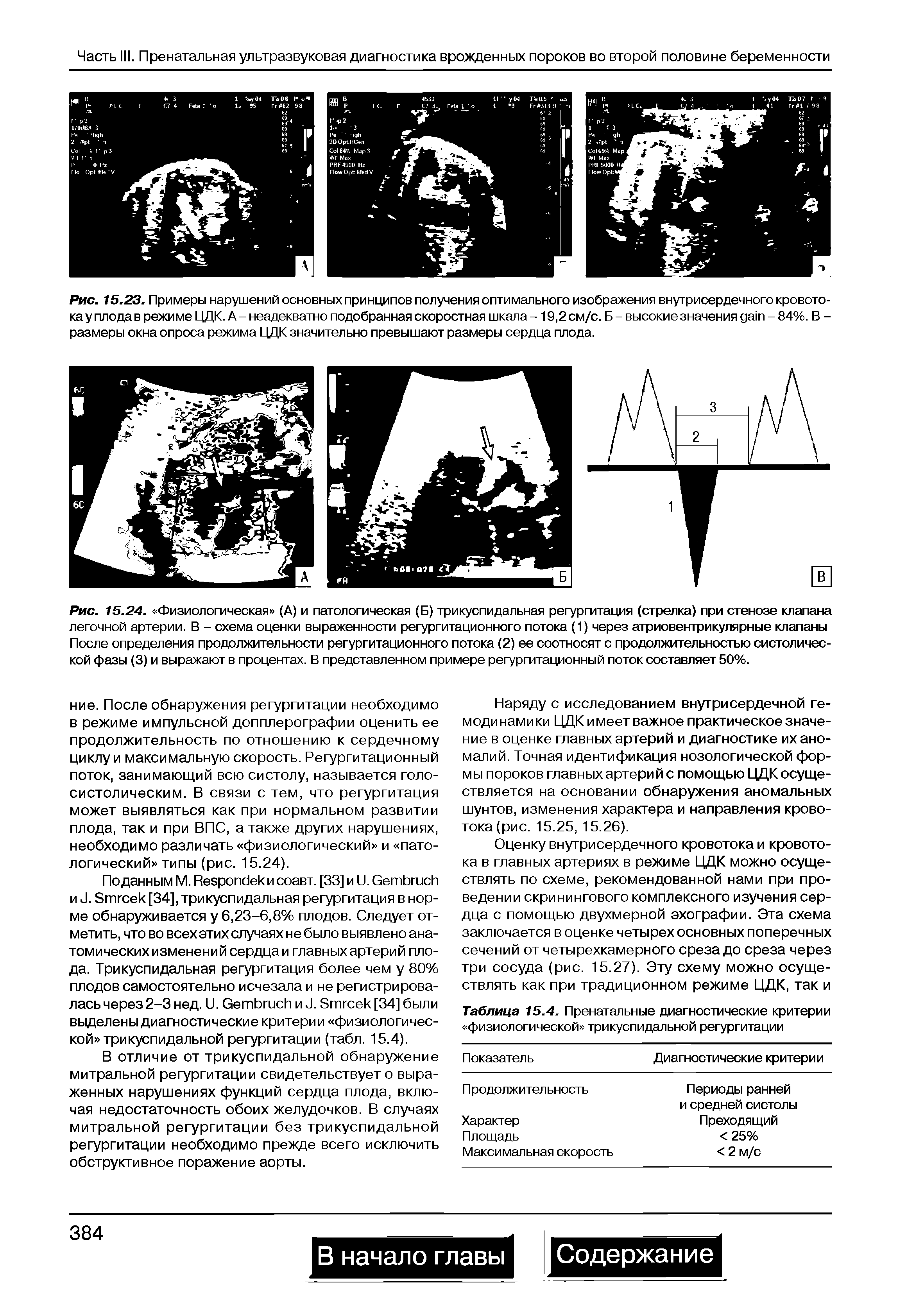 Рис. 15.23. Примеры нарушений основных принципов получения оптимального изображения внутрисердечного кровотока у плода в режиме ЦДК. А-неадекватно подобранная скоростная шкала - 19,2 см/с. Б-высокие значения да1п-84%. В -размеры окна опроса режима ЦДК значительно превышают размеры сердца плода.