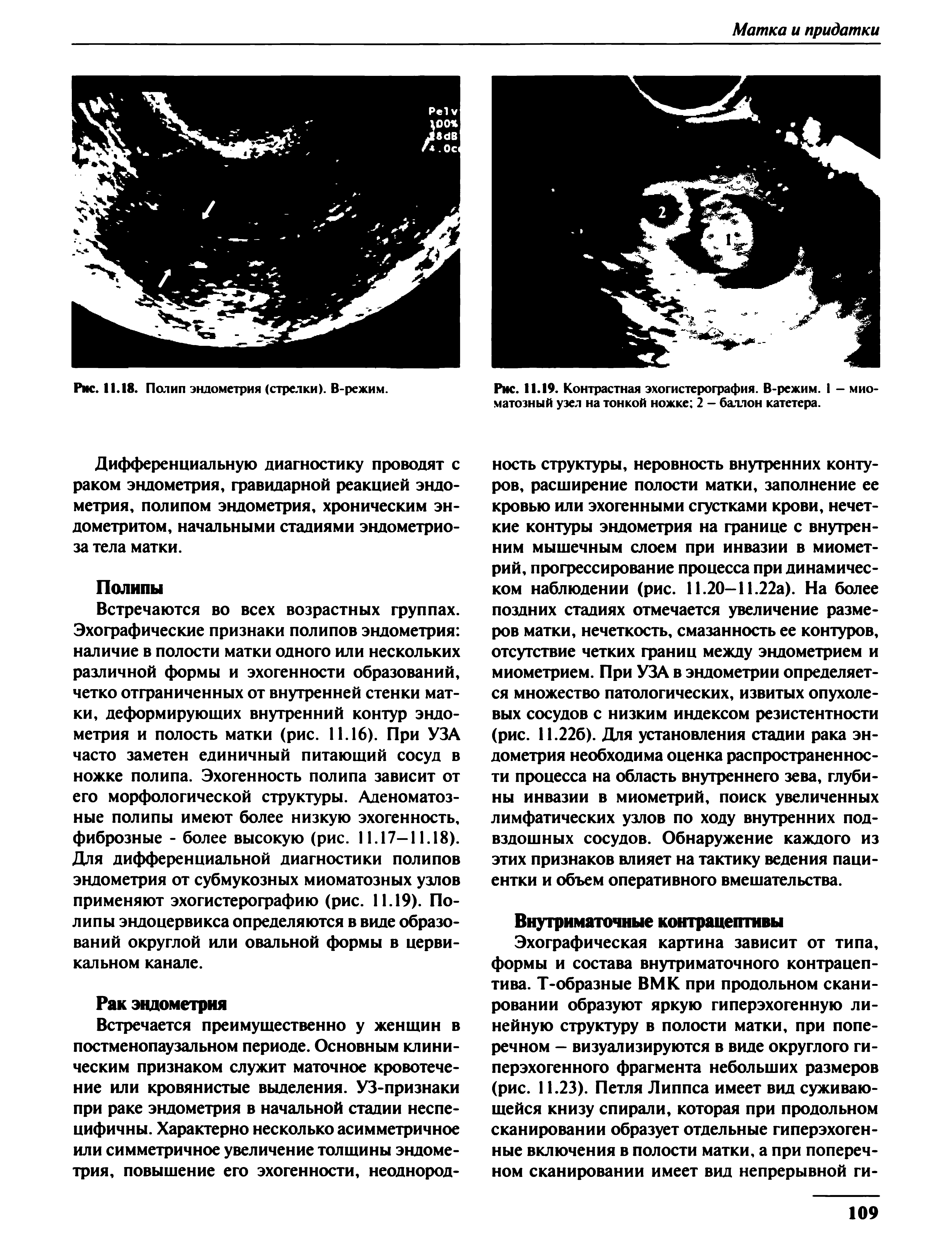 Рис. 11.19. Контрастная эхогистерография. В-режим. I - мкоматозный узел на тонкой ножке 2 - баллон катетера.