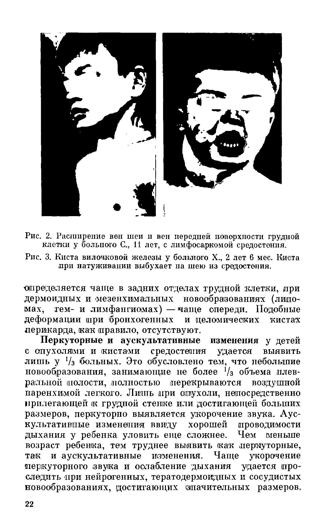 Рис. 3. Киста вилочковой железы у больного X., 2 лет 6 мес. Киста при натуживапии выбухает па шею из средостения.