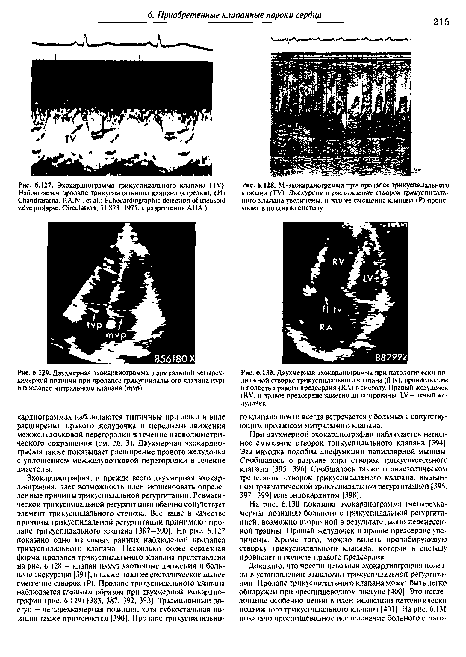 Рис. 6.127. Эхокардиограмма трикуспидального клапана (TV) Наблюдается пролапс трикуспидального клапана (стрелка), (На C . P.A.N.. . E . C , 51 823. 1975. с разрешения AHA )...