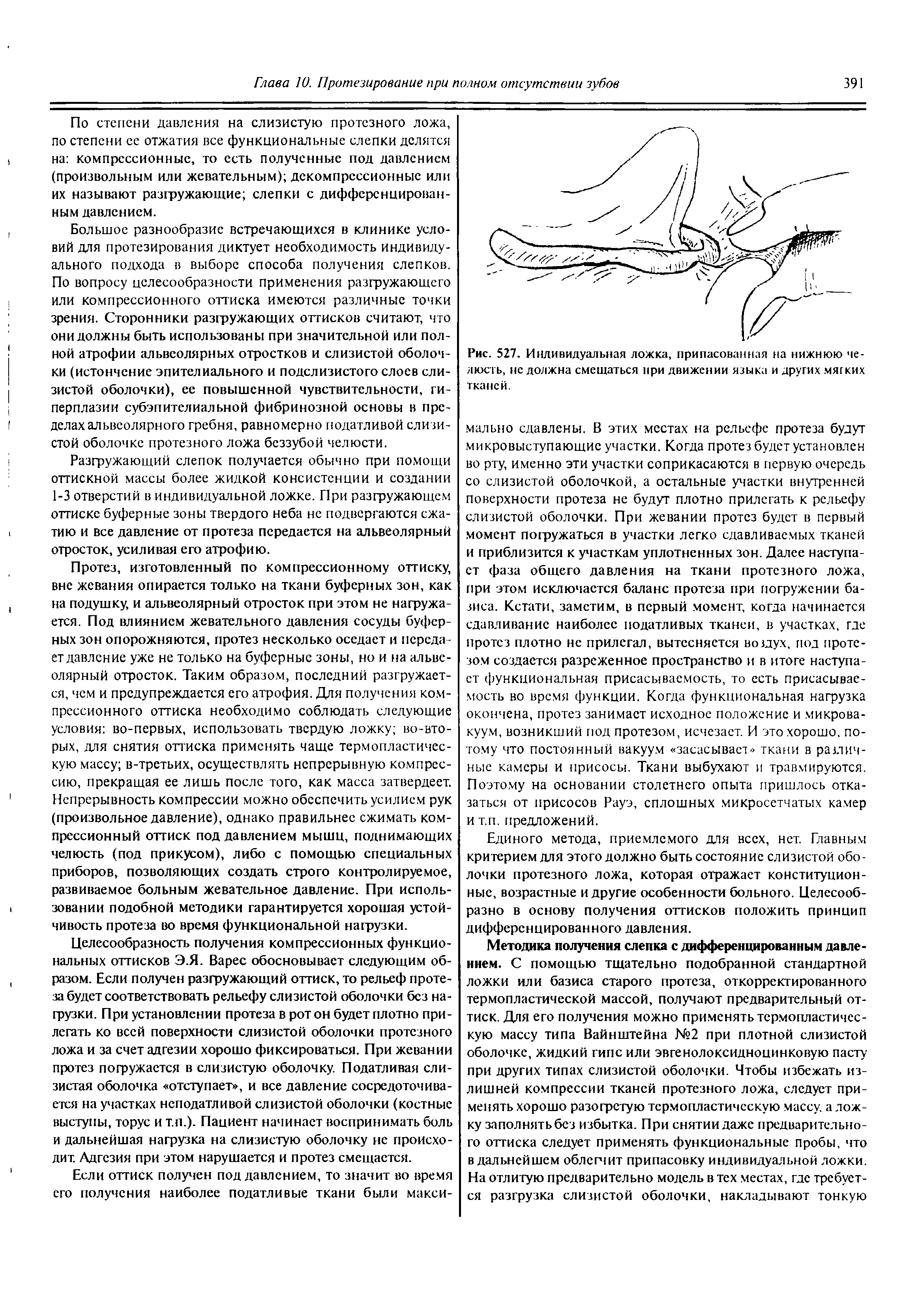 Рис. 527. Индивидуальная ложка, припасованная на нижнюю челюсть, нс должна смещаться при движении языка и других мягких тканей.