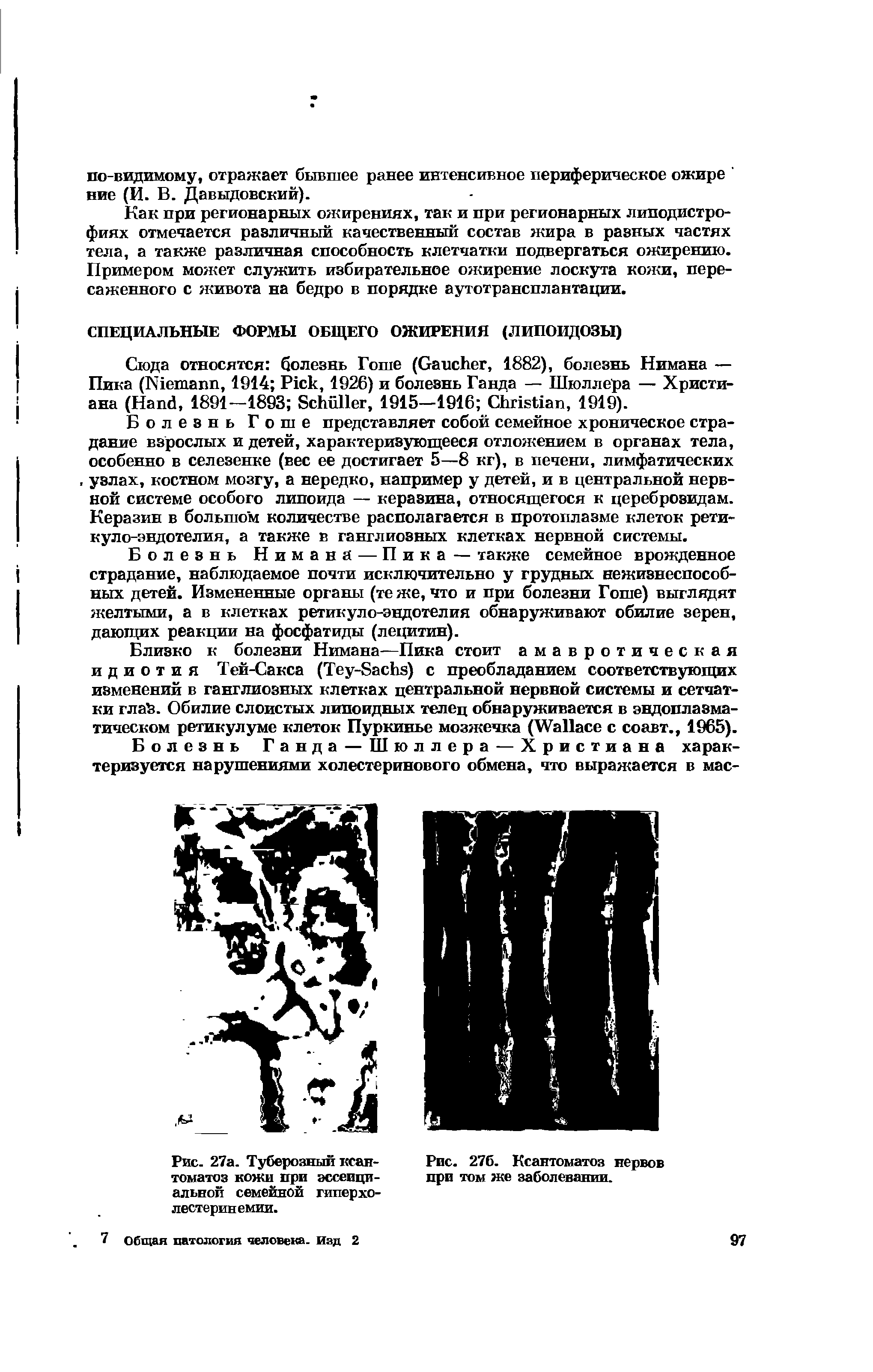 Рис. 27а. Туберозный ксантоматоз кожи при эссенциальной семейной гиперхолестеринемии.