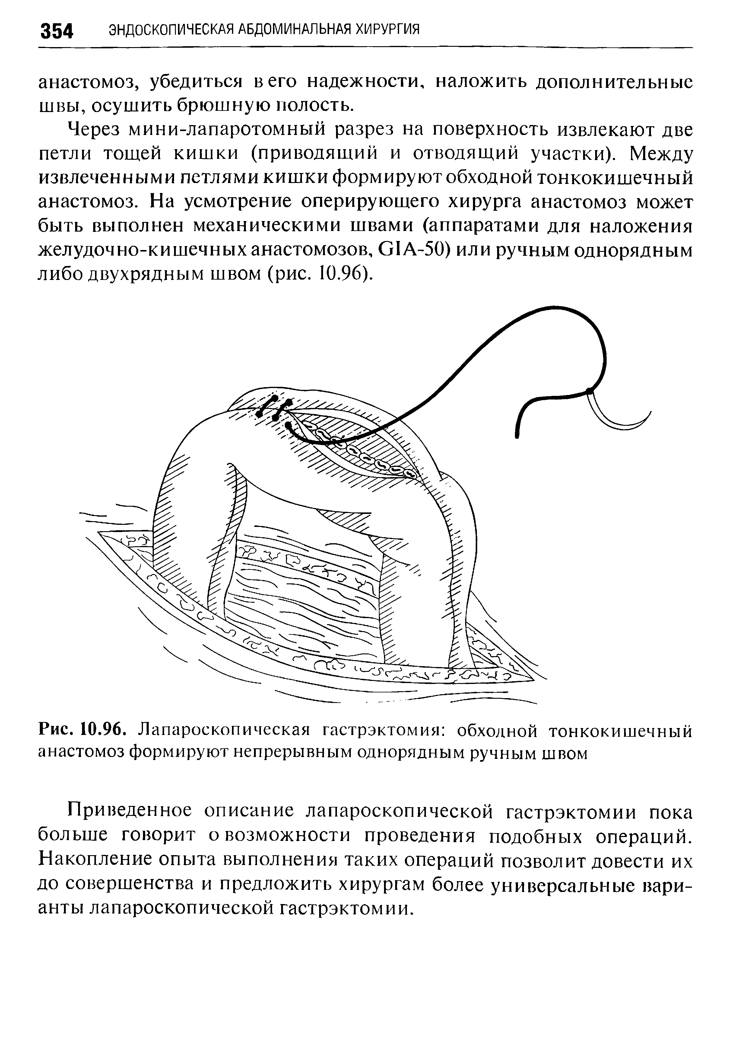 Рис. 10.96. Лапароскопическая гастрэктомия обходной тонкокишечный анастомоз формируют непрерывным однорядным ручным швом...
