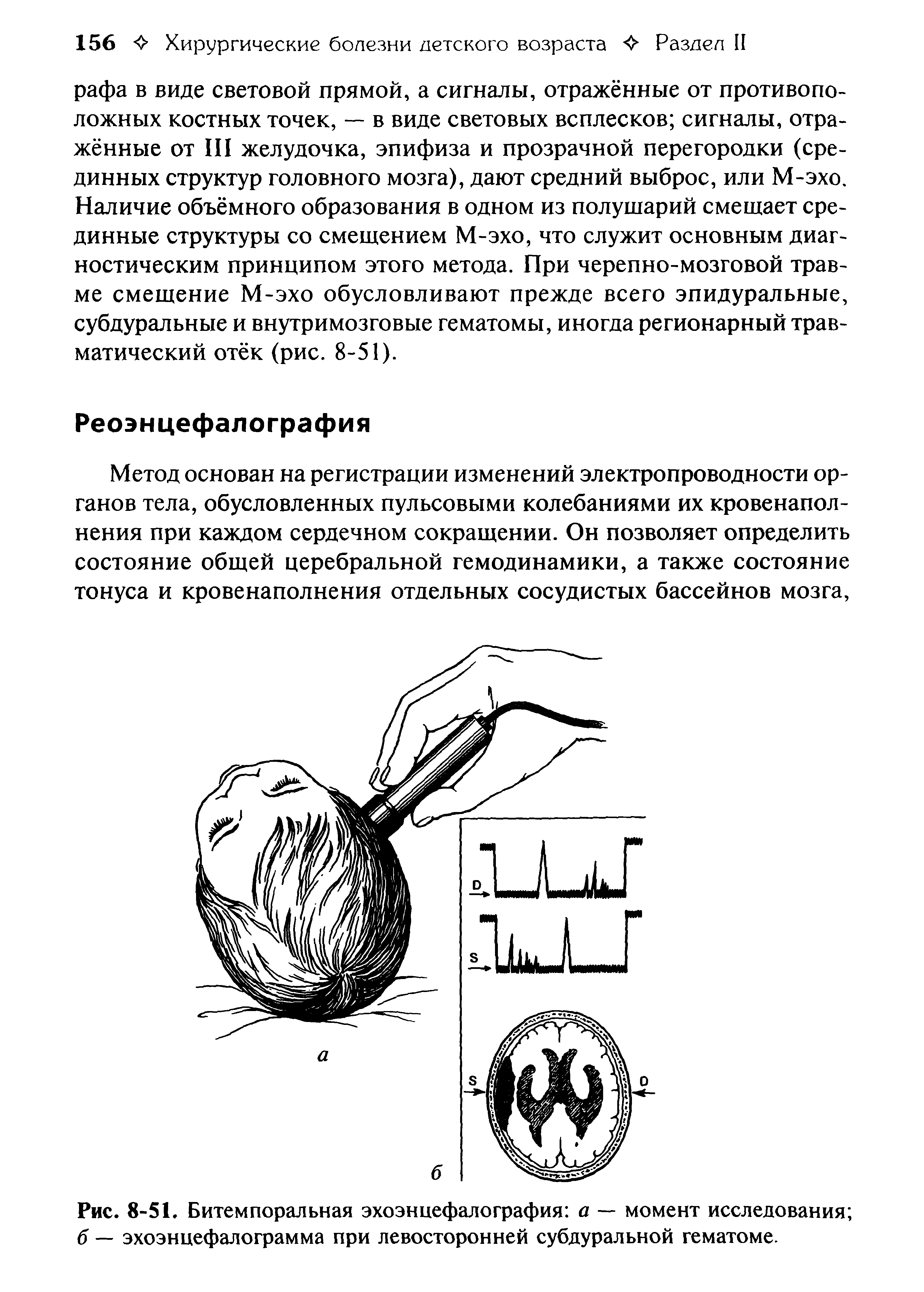 Рис. 8-51. Битемпоральная эхоэнцефалография а — момент исследования б — эхоэнцефалограмма при левосторонней субдуральной гематоме.