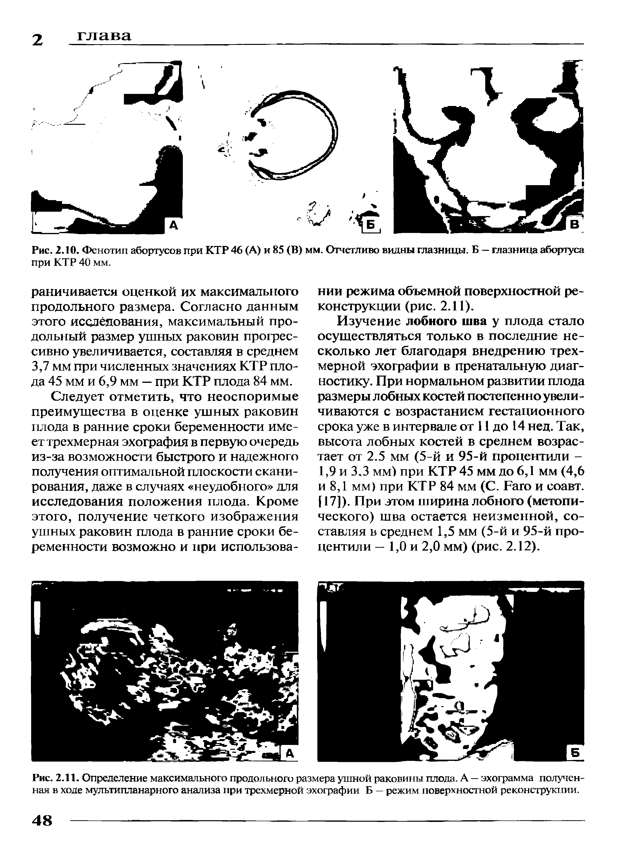 Рис. 2.10. Фенотип абортусов при КТР 46 (А) и 85 (В) мм. Отчетливо видны глазницы. Б — глазница абортуса при КТР 40 мм.