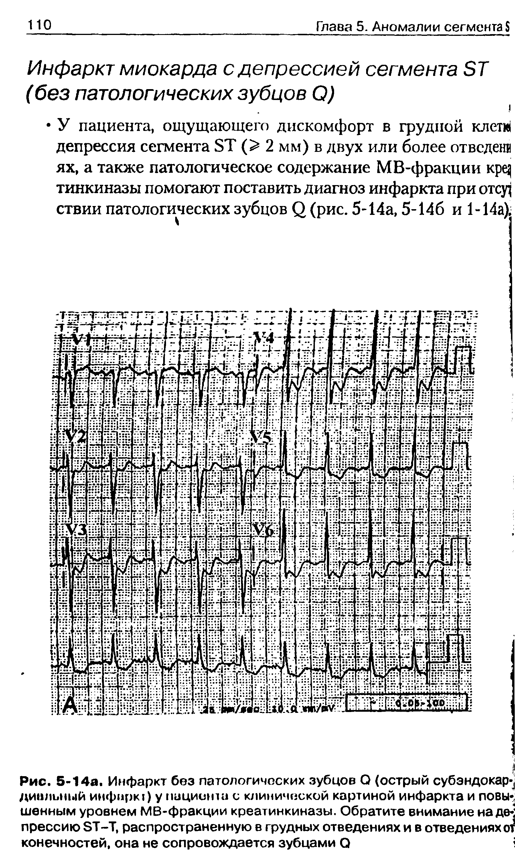 Рис. 5-14а. Инфаркт без патологических зубцов О (острый субэндокар ДИИЛЫН.1Й инфнрк ) у пиции па с клинической картиной инфаркта и повышенным уровнем МВ-фракции креатинкиназы. Обратите внимание надо- прессию ЭТ-Т, распространенную в грудных отведениях и в отведениях от конечностей, она не сопровождается зубцами О ...