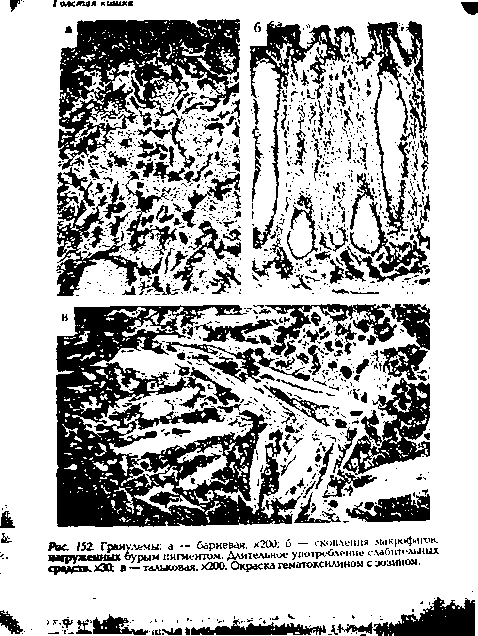 Рис. 151 Гранулемы а - бариевая. х200 б - скопления нагруженных бурым пигментом. Длительное употребление л Г> ггслы<ых жЭОс В — тальковая. х200. Окраска гематоксилином с эозином.