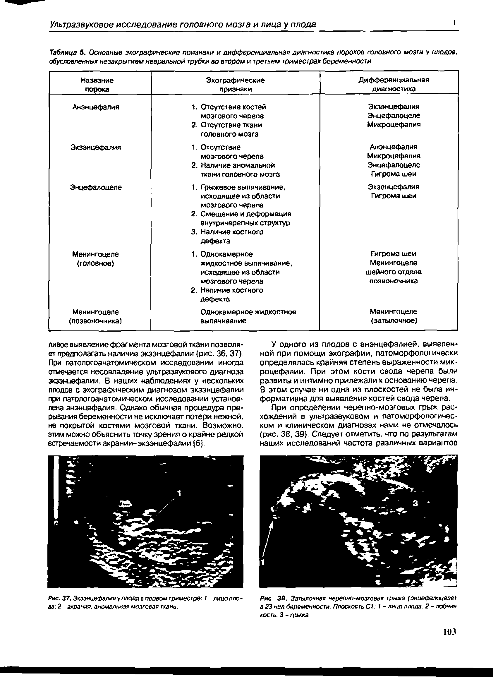 Таблица 5. Основные эхографические признаки и дифференциальная диагностика пороков головного мозга у плодов, обусловленных незакрытием невральной трубки во втором и третьем триместрах беременности...