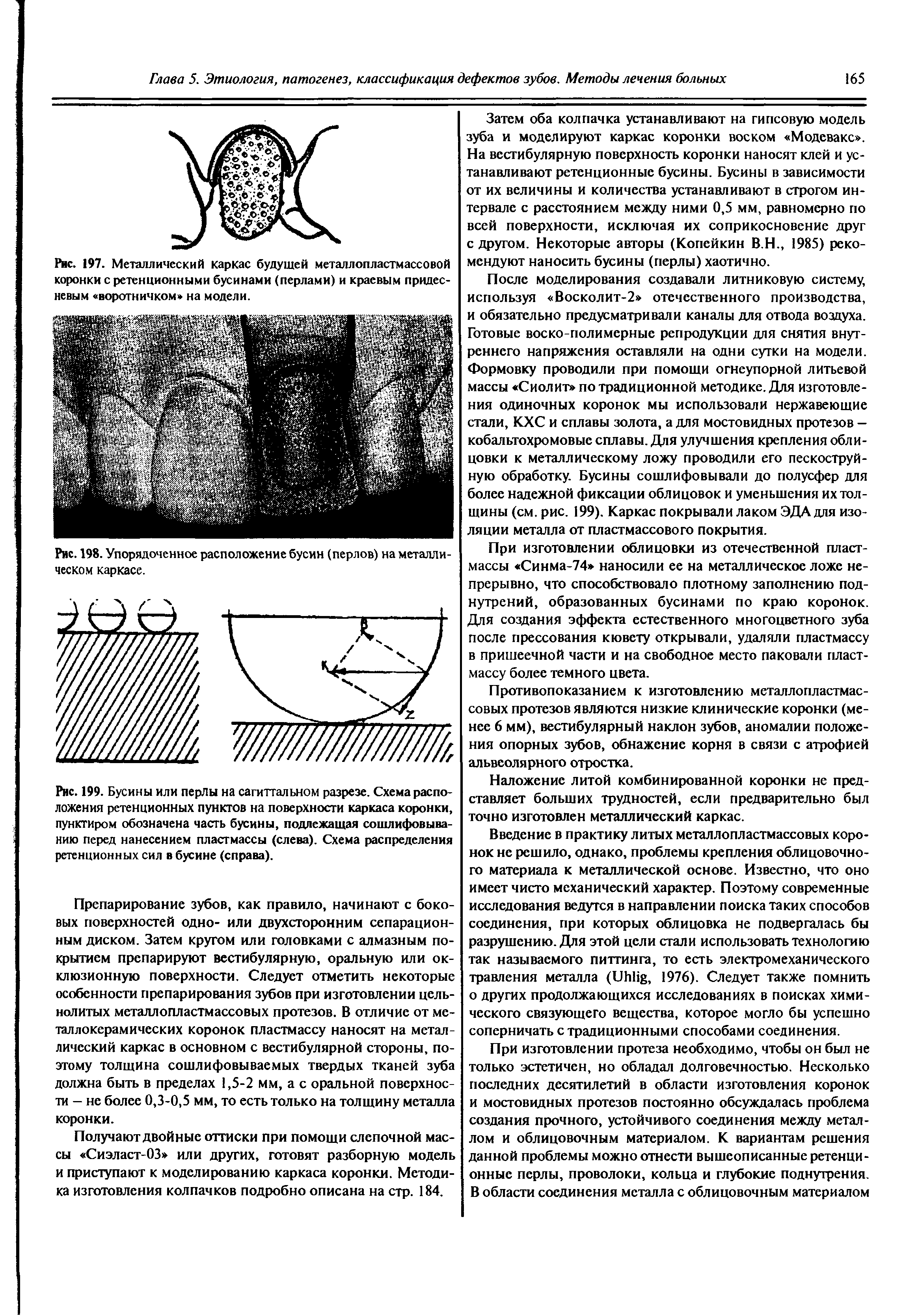 Рис. 197. Металлический каркас будущей металлопластмассовой коронки с ретенционными бусинами (перлами) и краевым придес-невым воротничком на модели.