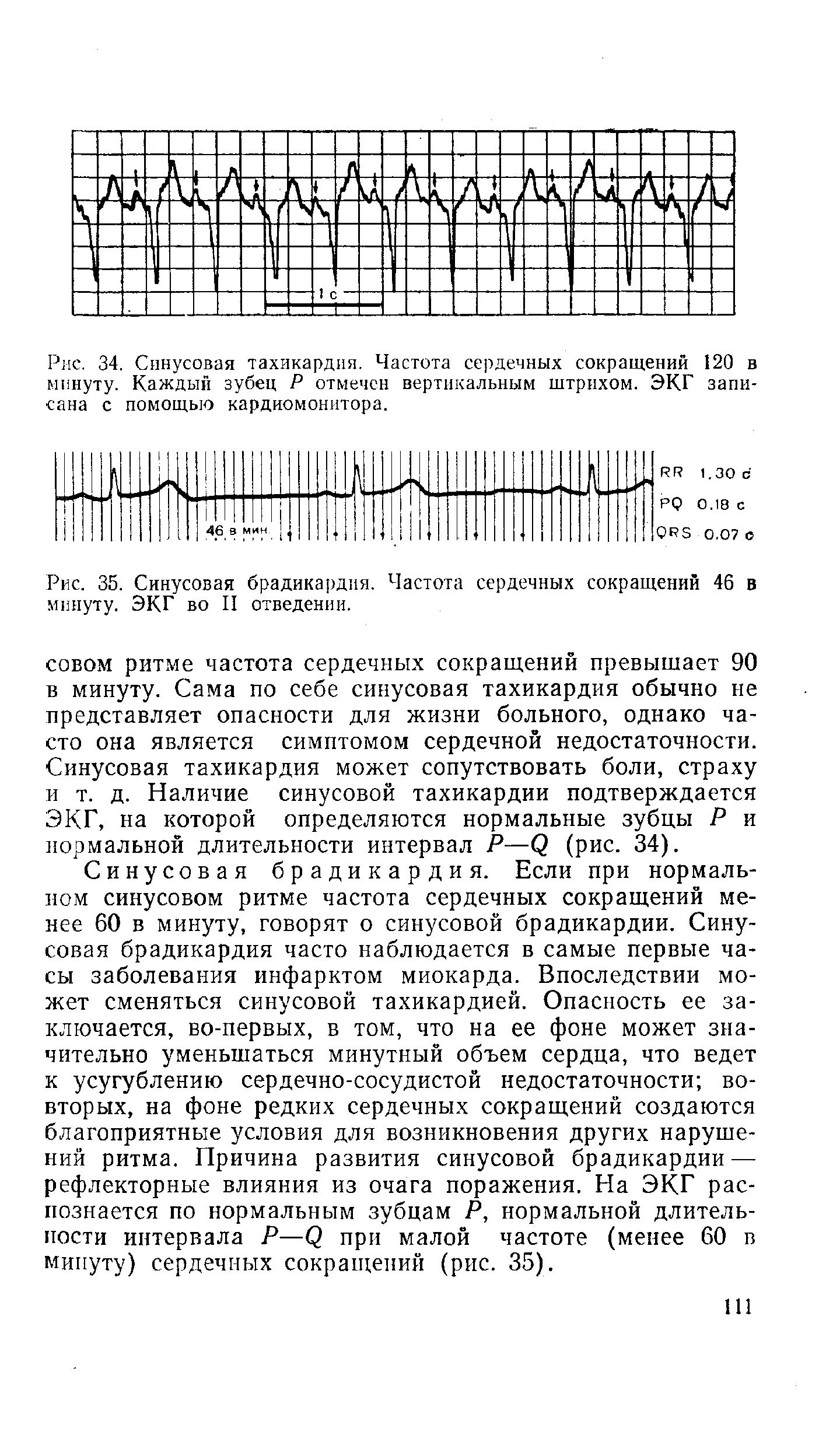 Рис. 35. Синусовая брадикардия. Частота сердечных сокращений 46 в минуту. ЭКГ во II отведении.