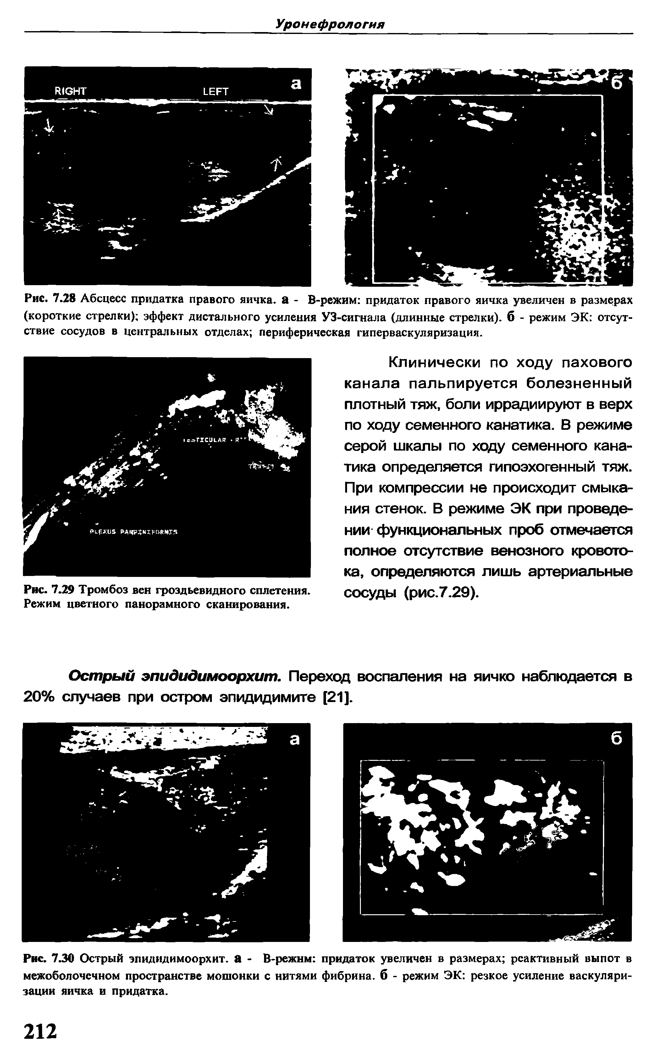 Рис. 7.30 Острый эпидидимоорхит. а - В-режнм придаток увеличен в размерах реактивный выпот в межоболочечном пространстве мошонки с нитями фибрина, б - режим ЭК резкое усиление васкуляризации яичка и придатка.