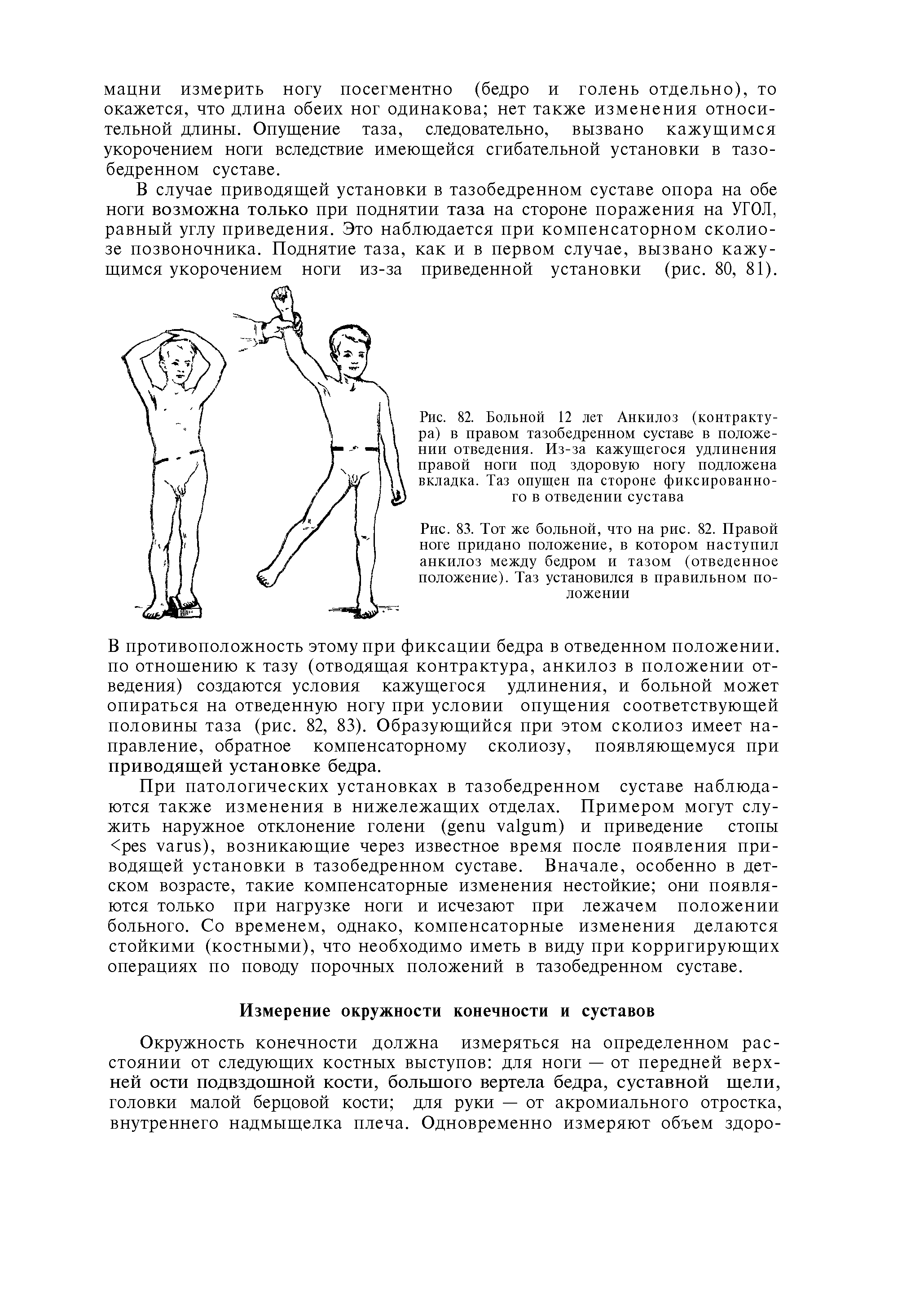 Рис. 82. Больной 12 лет Анкилоз (контрактура) в правом тазобедренном суставе в положении отведения. Из-за кажущегося удлинения правой ноги под здоровую ногу подложена вкладка. Таз опущен па стороне фиксированного в отведении сустава...