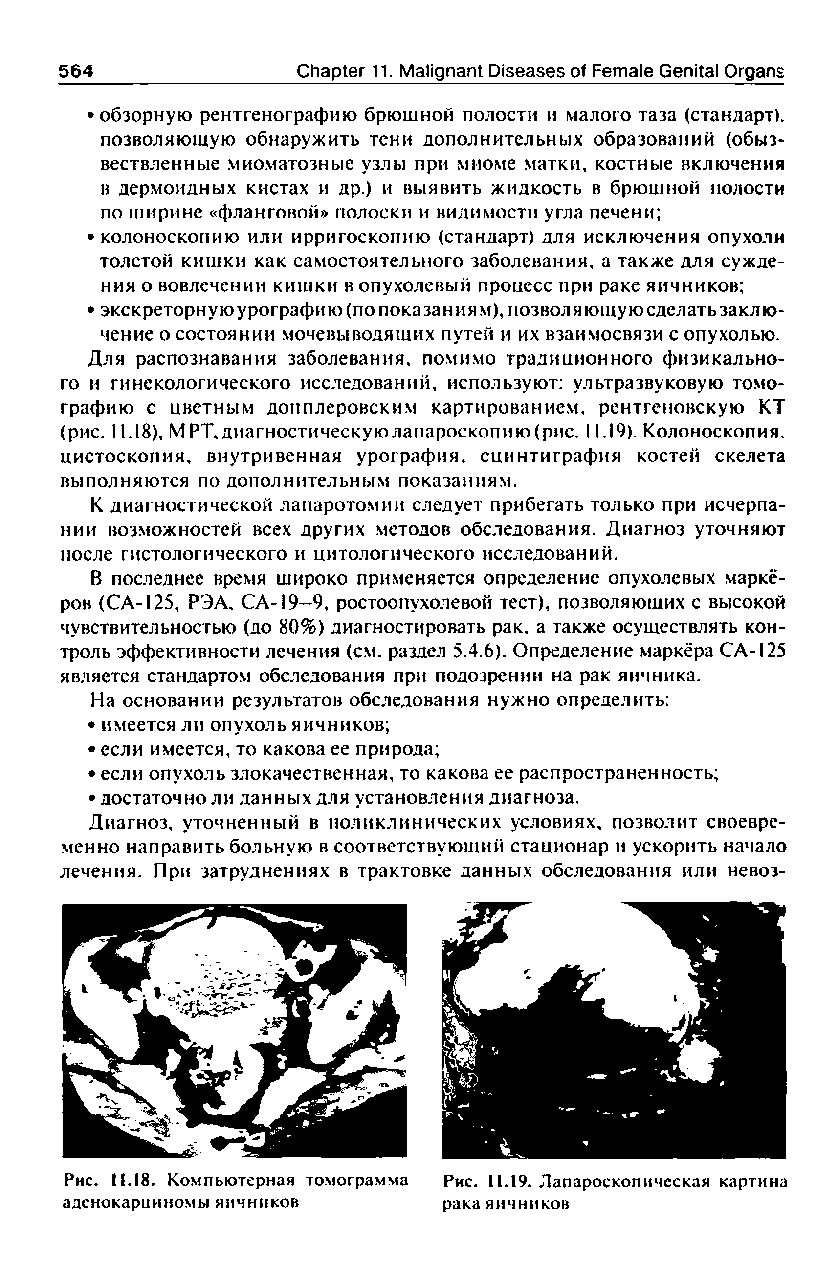 Рис. 11.18. Компьютерная томограмма Рис. 11.19. Лапароскопическая картина аденокарциномы яичников рака яичников...