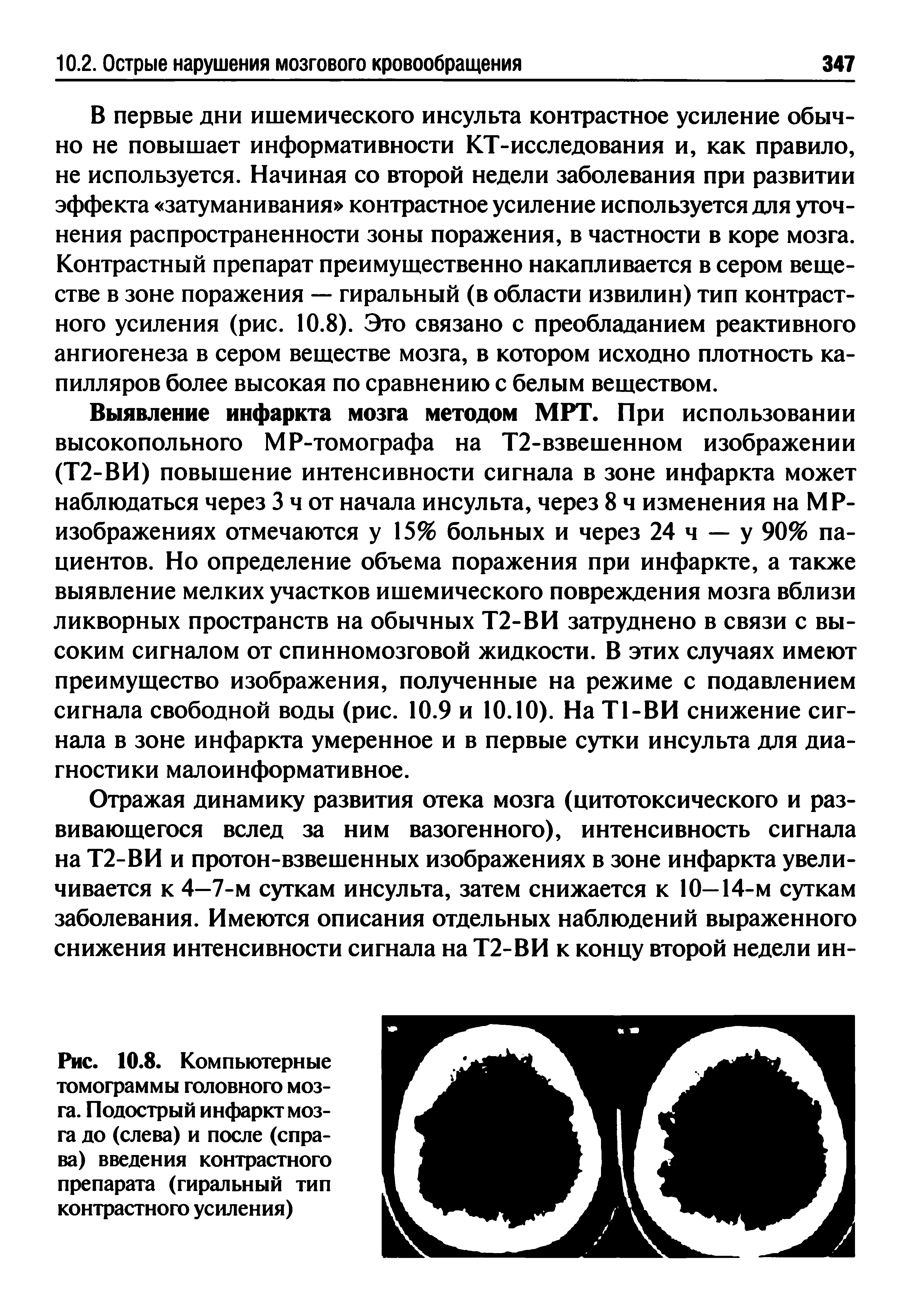 Рис. 10.8. Компьютерные томограммы головного мозга. Подострый инфаркт мозга до (слева) и после (справа) введения контрастного препарата (гиральный тип контрастного усиления)...