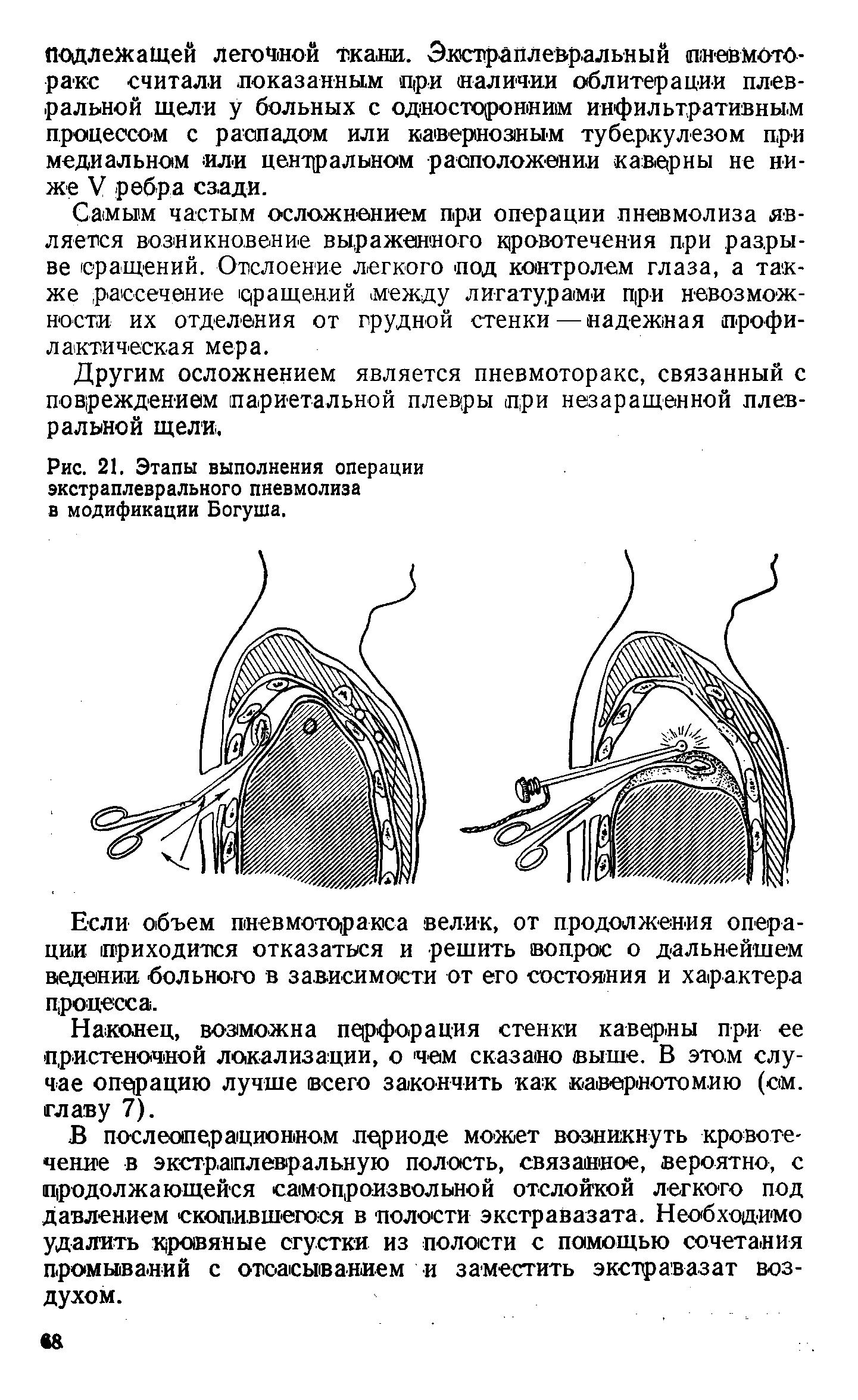 Рис. 21. Этапы выполнения операции экстраплеврального пневмолиза в модификации Богуша.