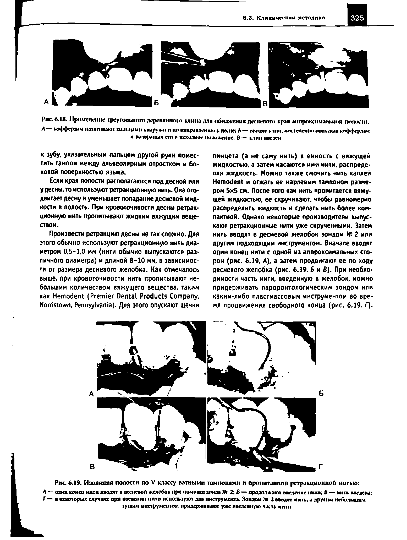 Рис. 6.18. Применение треугольною деревянною клина для обнажения десневого края аиироксимл п.иой полосгм А коффердам иатягшиют пальцами кнаружи и по направлению к десне Ь — в(и>дяг клип. 1ик1епенно ошусмя кофердам и волвращая его г исходное положение Н — клин введен...