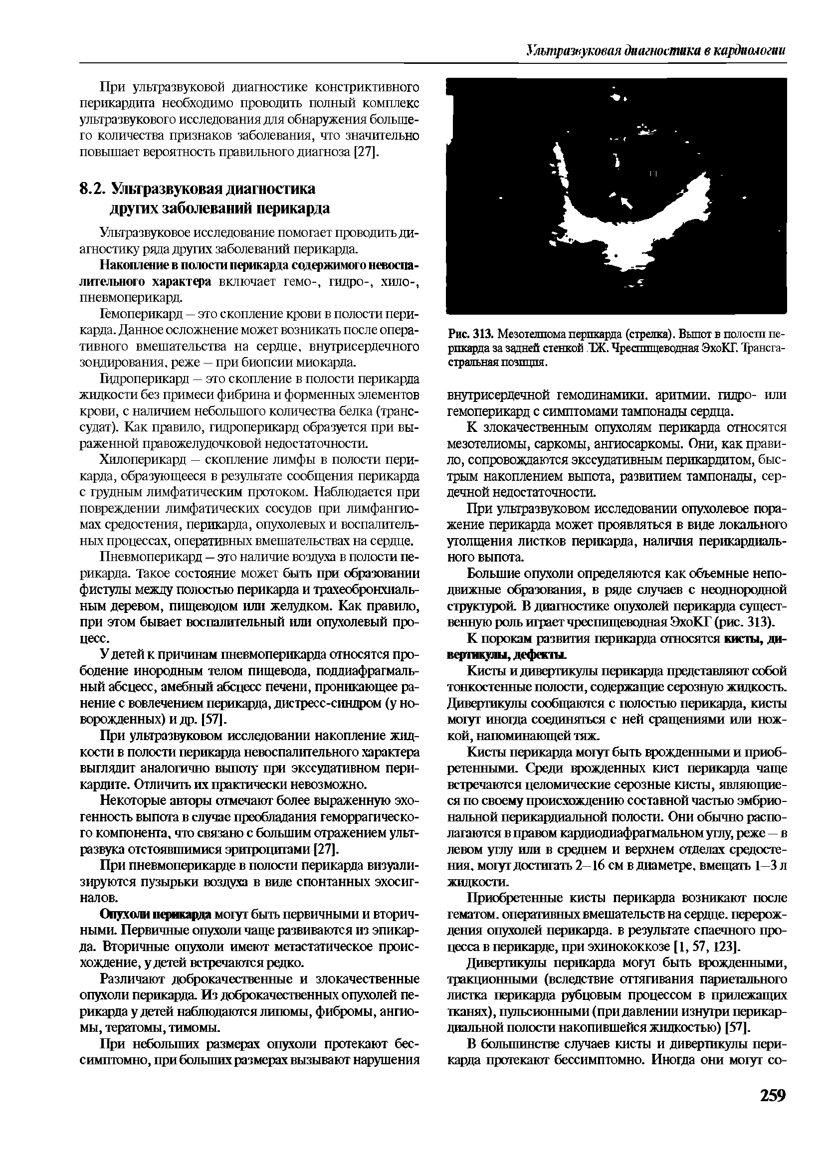 Рис. 313. Мезотелиома перикарда (стрелка). Выпот в полости пе-рпкарда за задней стенкой ГЖ. Чреспищеводная ЭхоКГ. Трансгастральная позиция.