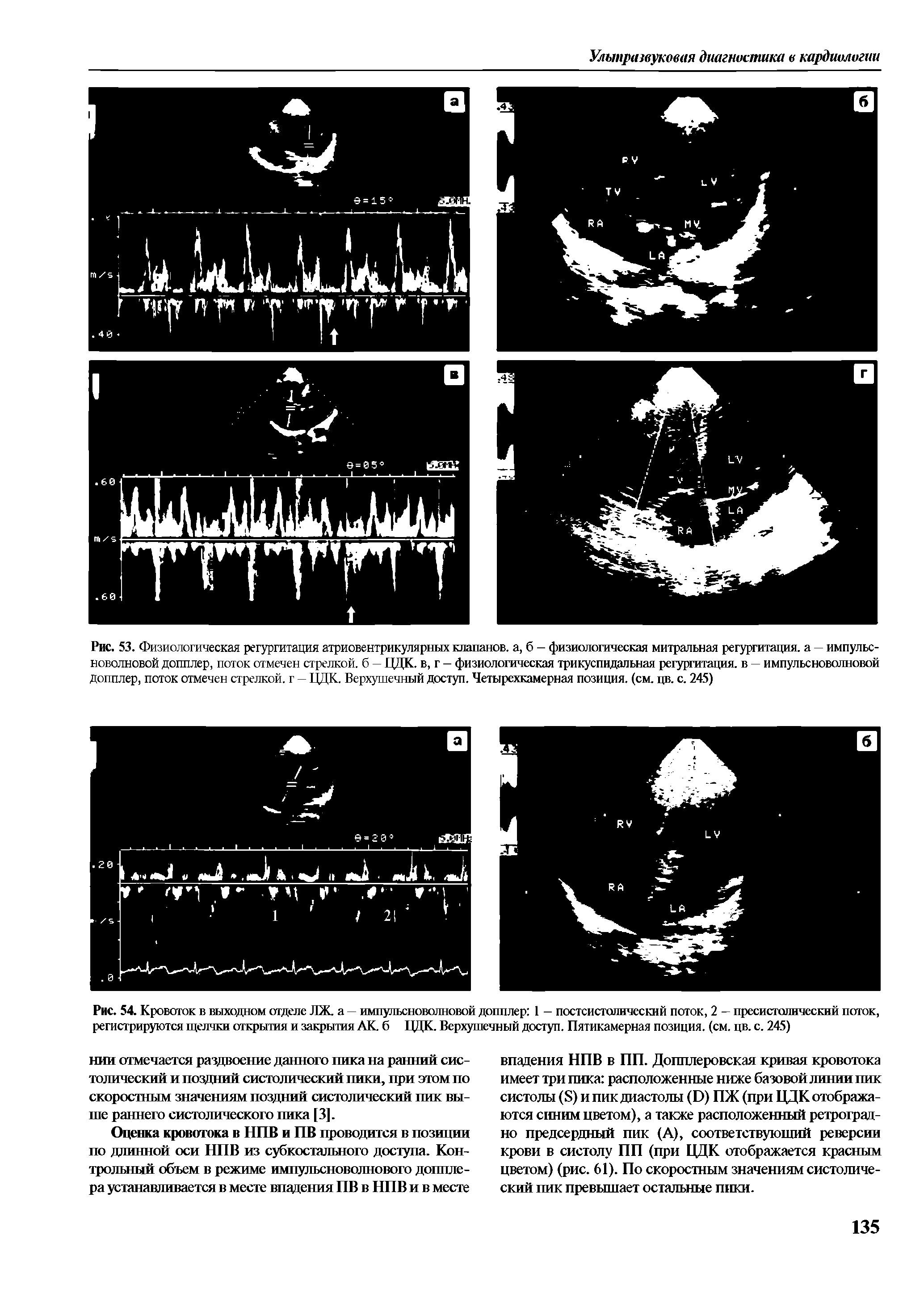 Рис. 54. Кровоток в выходном отделе ЛЖ. а — импульсноволновой допплер 1 — постсистолический поток, 2 - пресистолический поток, регистрируются щелчки открытия и закрытия АК б ЦДК. Верхушечный доступ. Пятикамерная позиция, (см. цв. с. 245)...